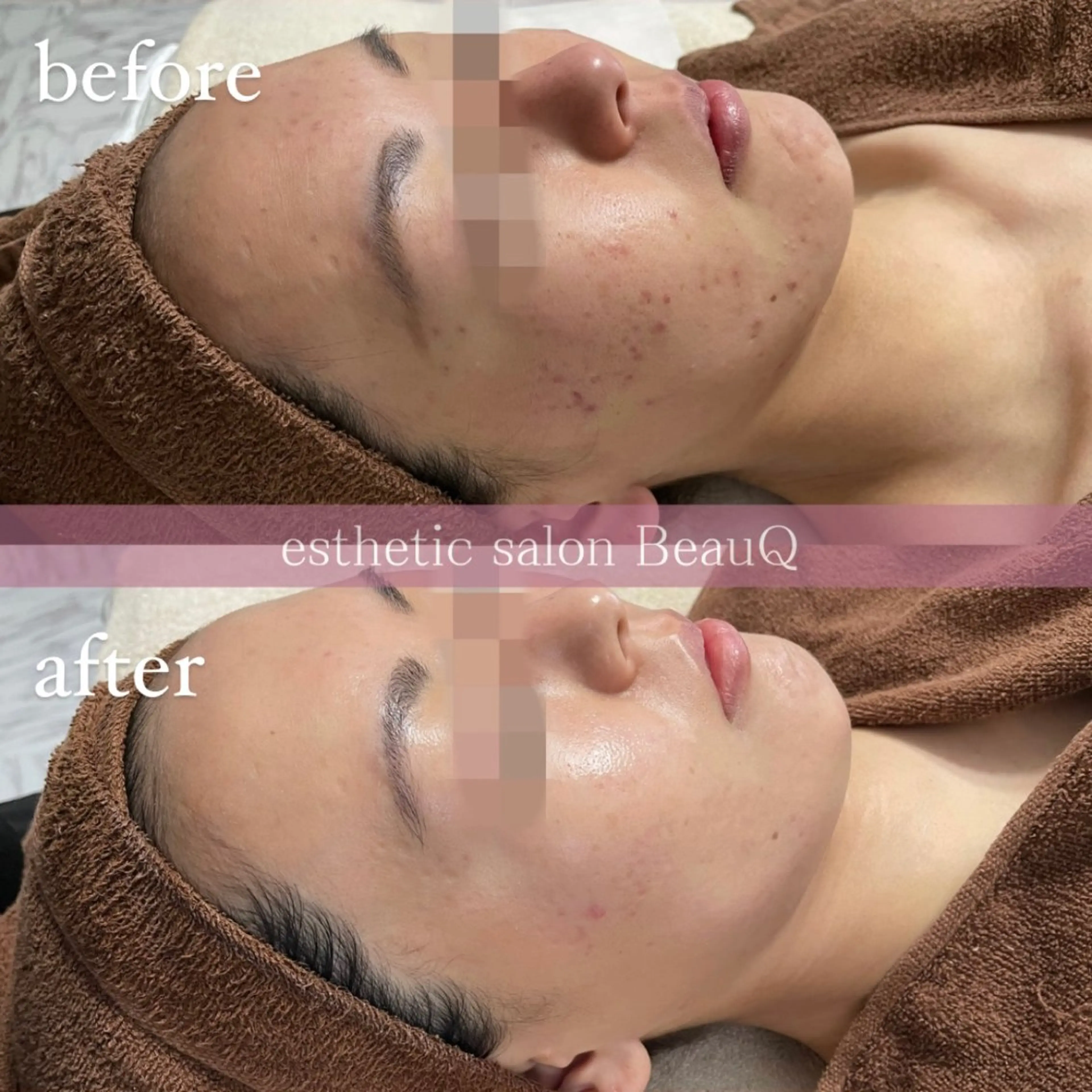 肌質改善/ブライダル 水上百華のエステ・リラクイメージ