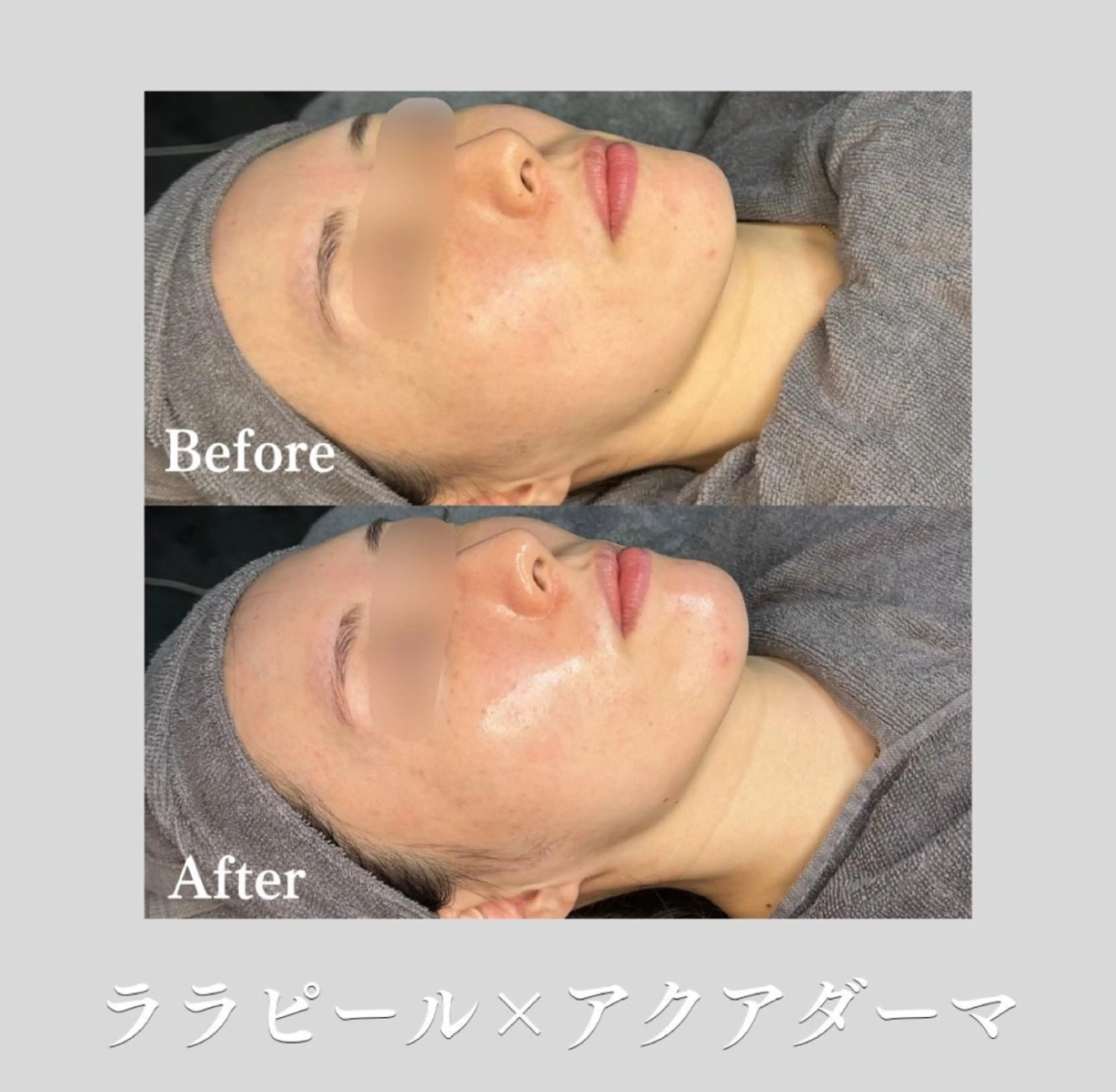 【冬の乾燥対策に☃️❄️】ララピール🫧+『お好きな美容液』超音波導入+保湿パック✨の写真