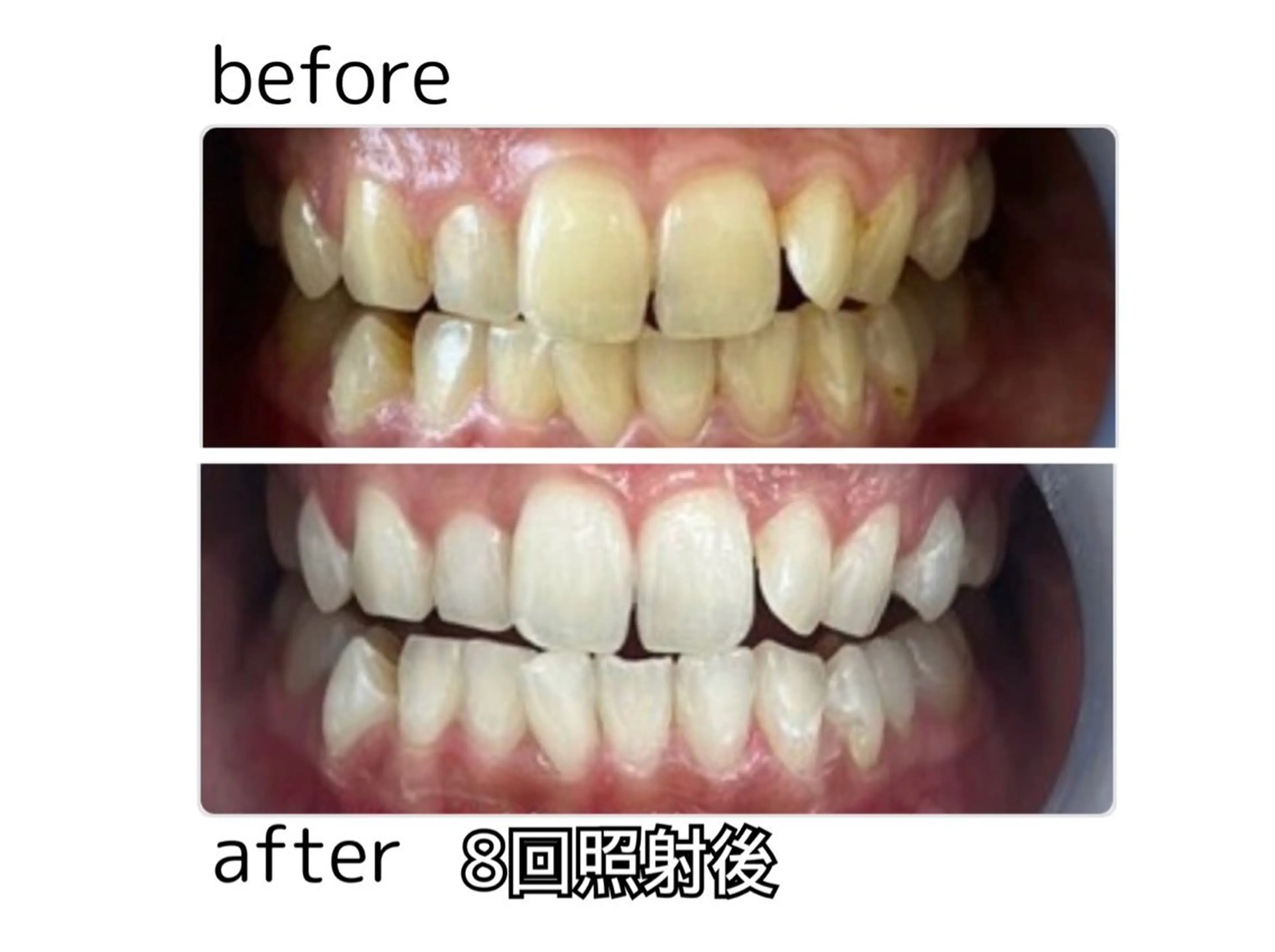 《お試し》セルフホワイトニング×1回照射の写真
