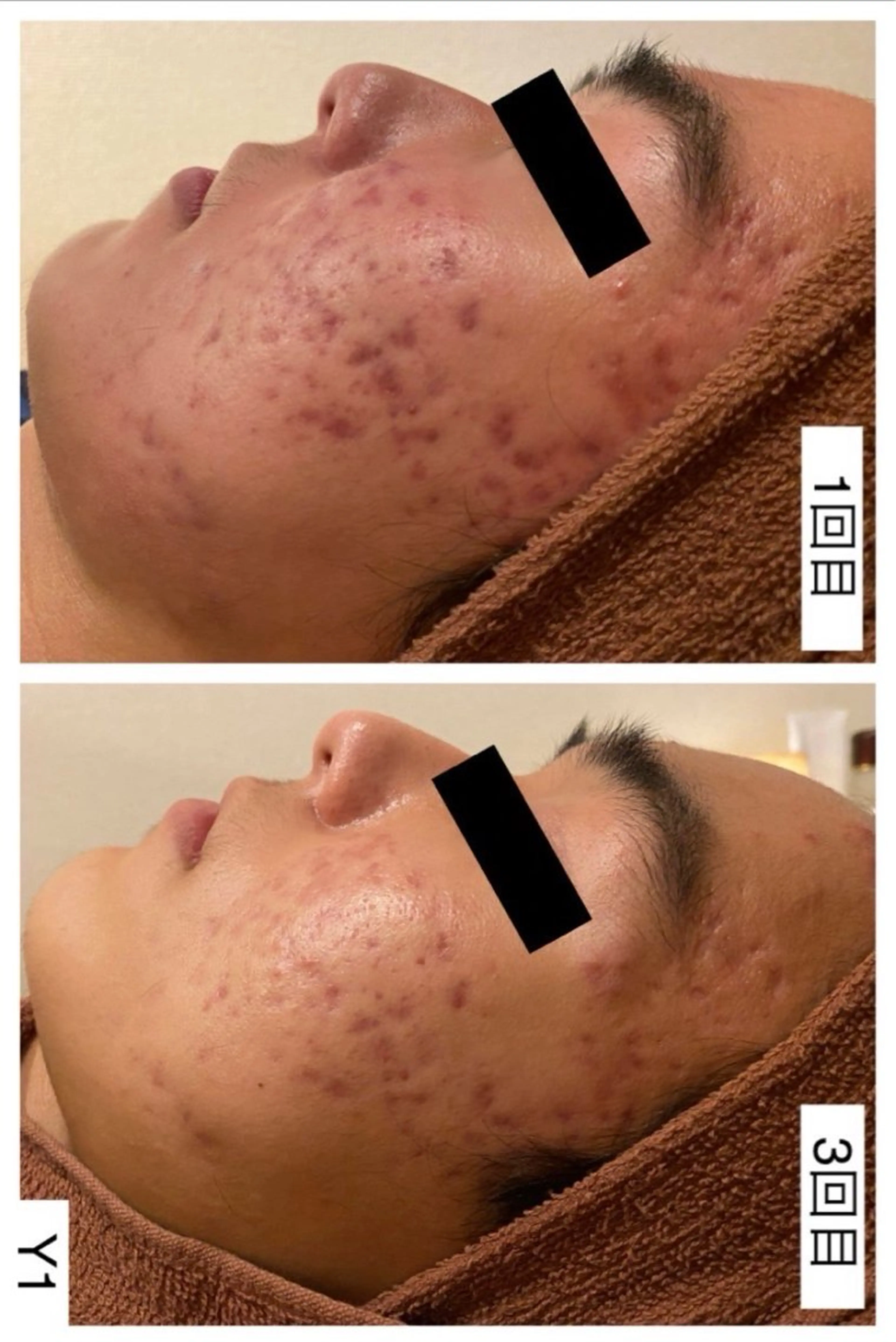 学生ニキビ改善🍀 優しい肌質改善のエステ・リラクイメージ