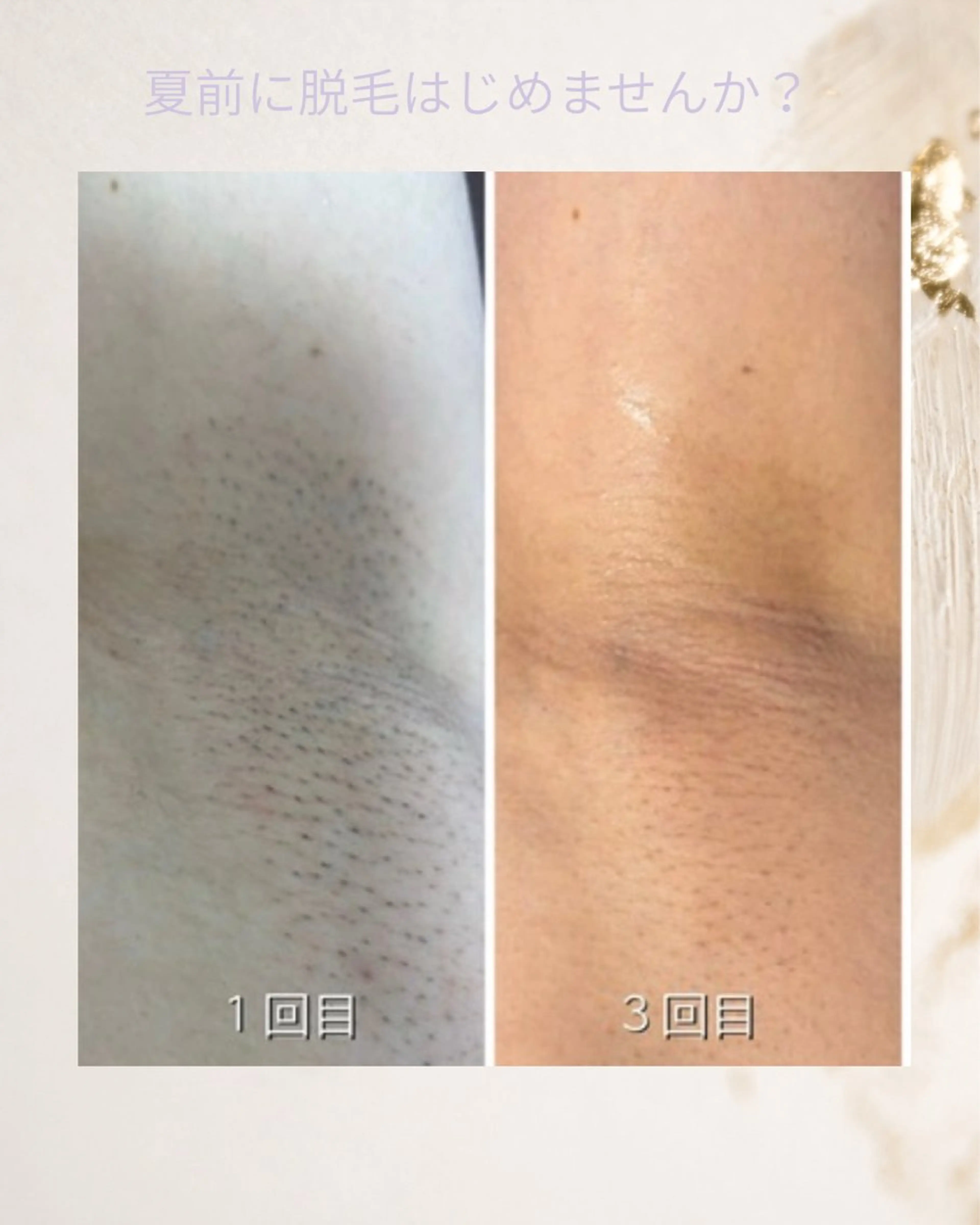 脱毛 女性専用 Lily新原のエステ・リラクイメージ