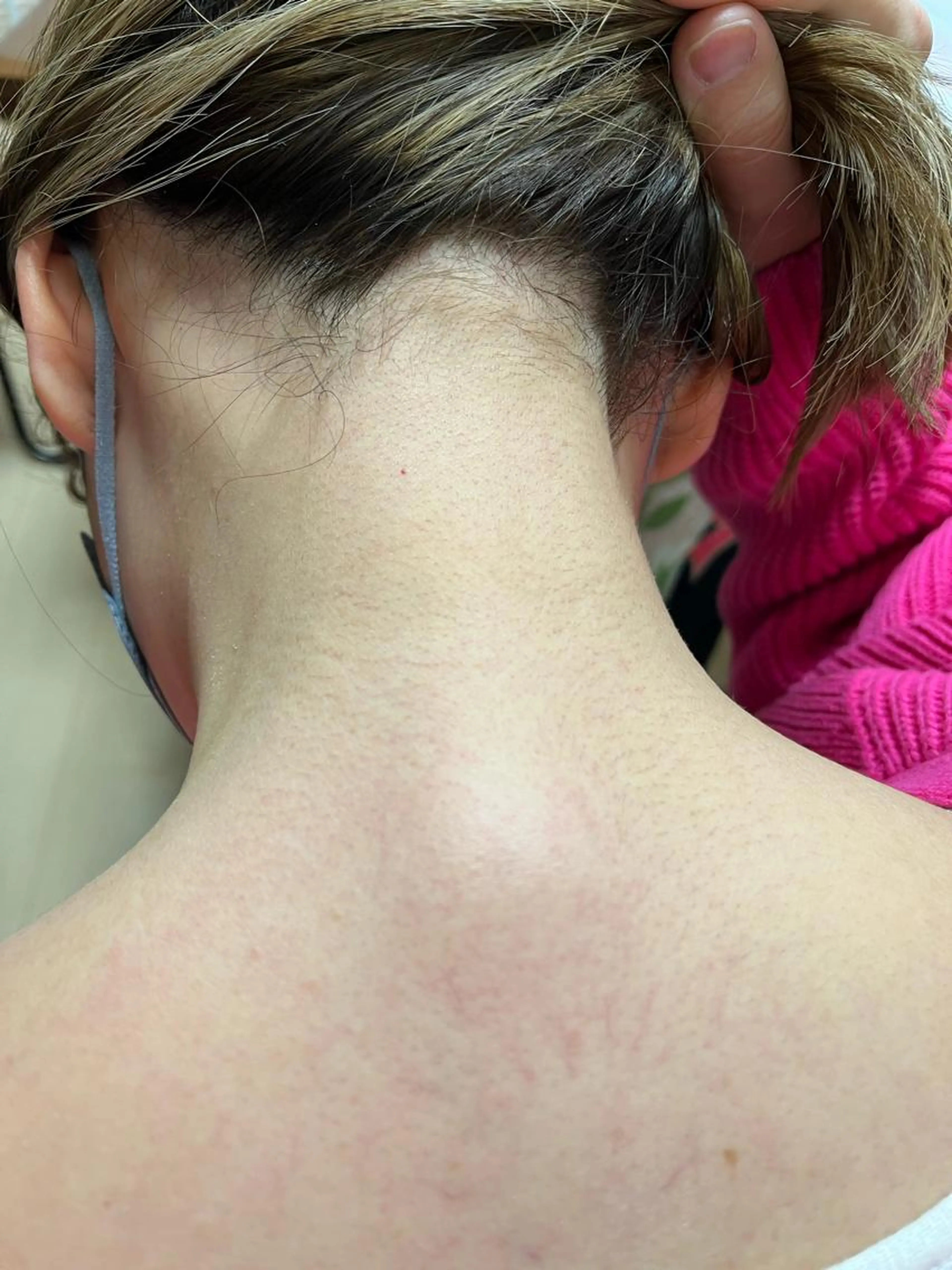 シュガーリング脱毛背中オール（肩甲骨​〜​ウエストライン）の写真