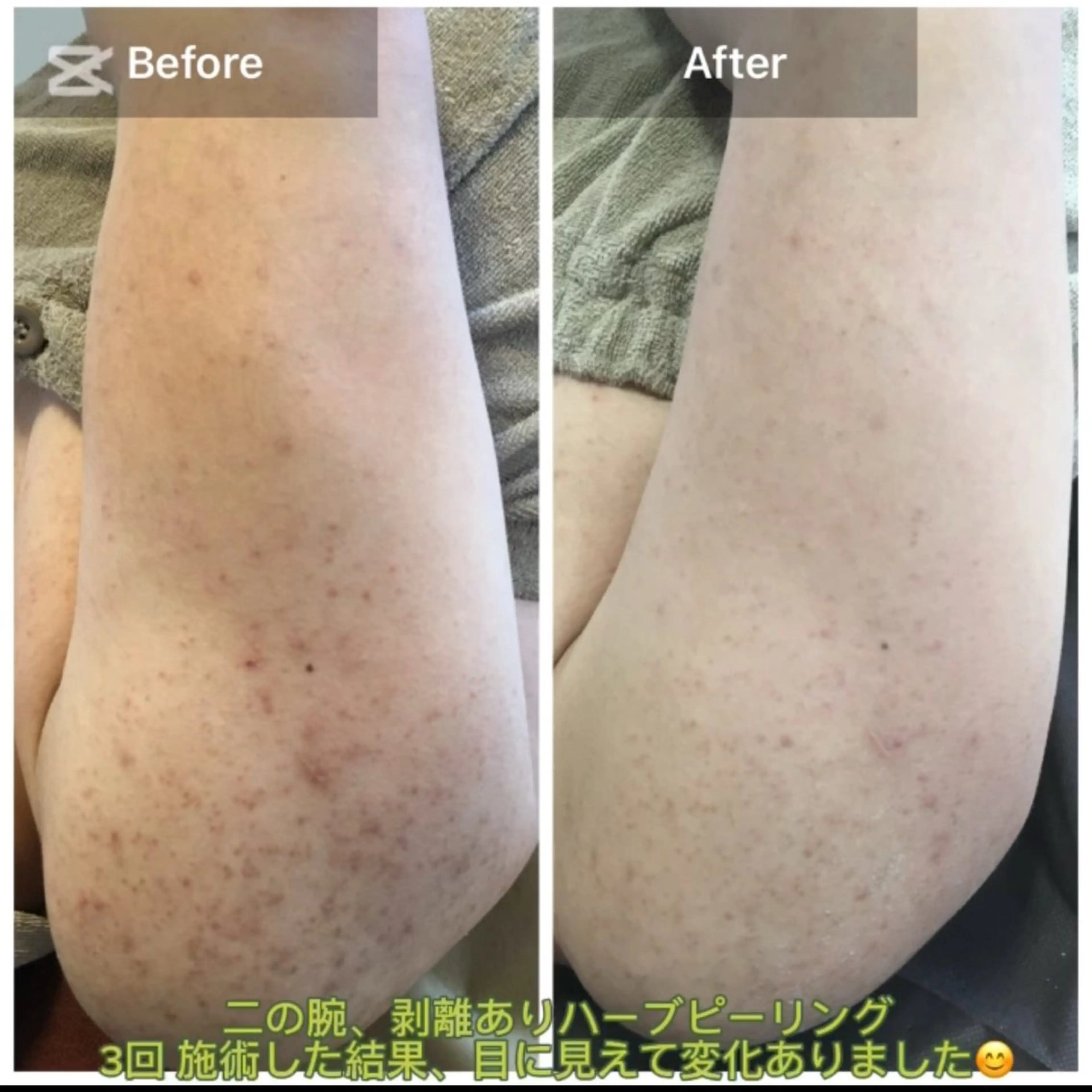 🌿二の腕ハーブピーリング✨【剥離あり】【毛穴洗浄】【GF美容液】ニキビ/ニキビ跡/黒ずみ/水光肌/毛穴ケア/毛孔性苔癬の写真