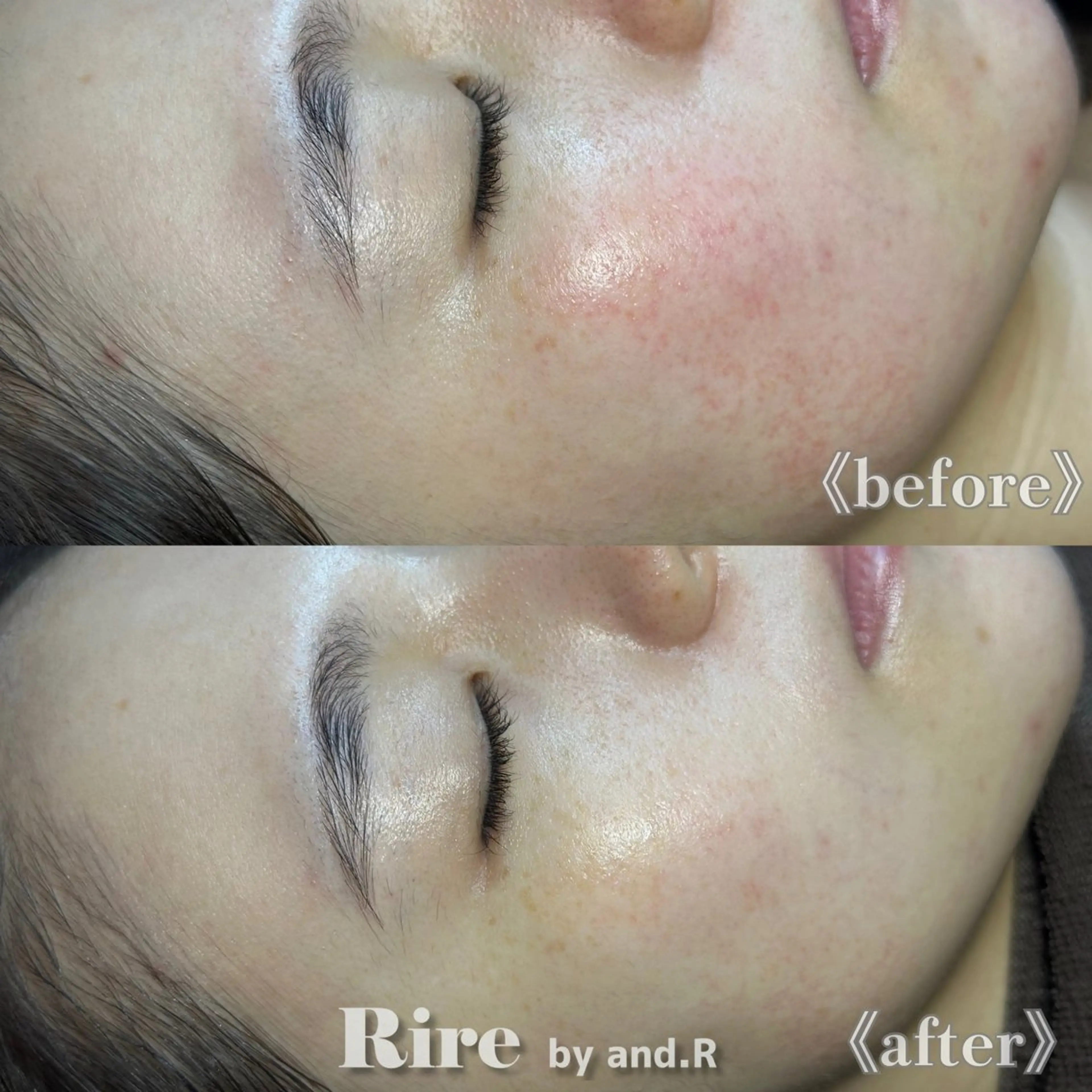 【当日限定✨】水光肌ララピール(顔＋首)¥12,000→¥8,800の写真