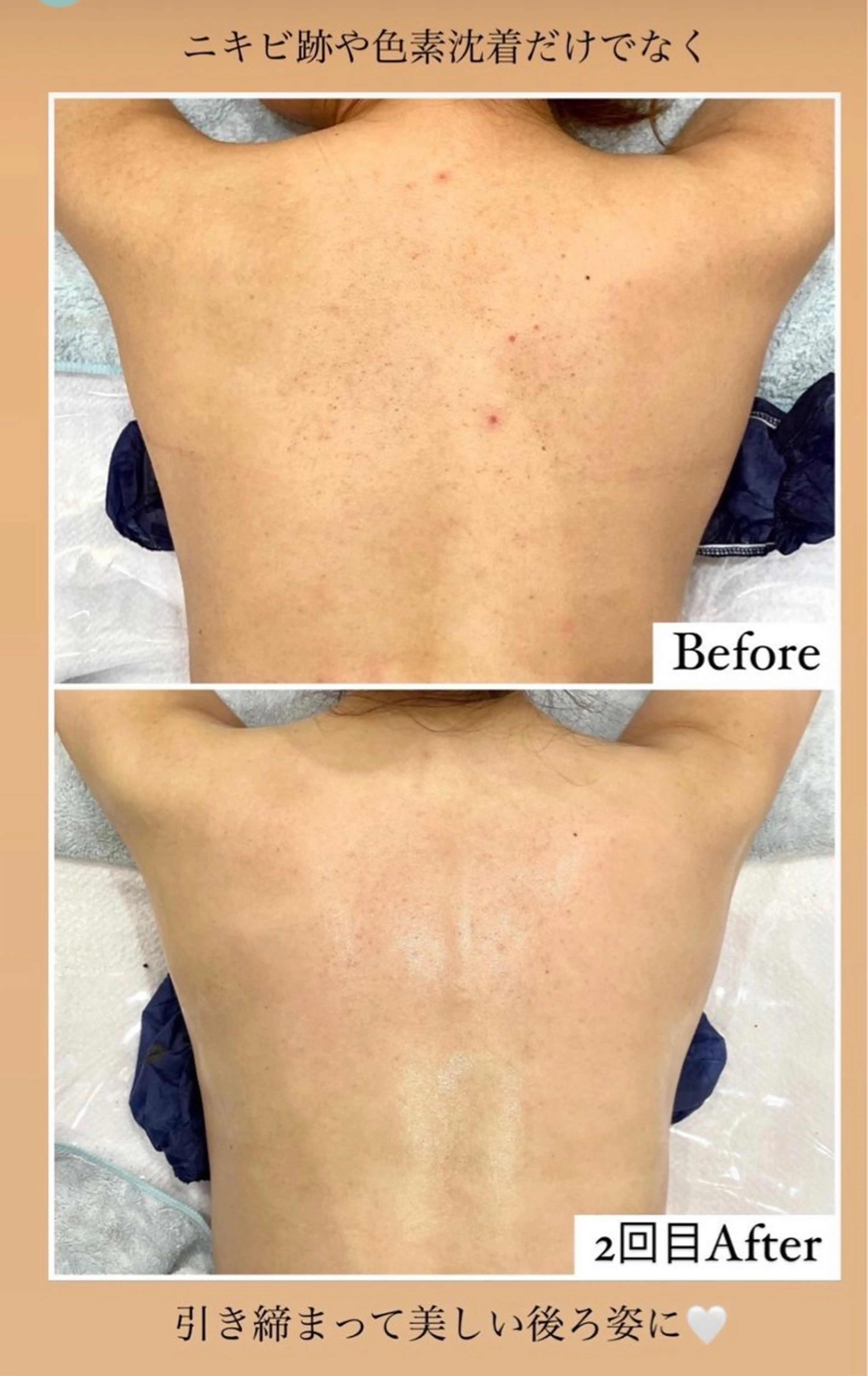 ハーブピーリング/韓国肌管理/フェイシャル/毛穴洗浄/眉毛/顔脱毛【糸脱毛専門】rev所属・ハーブピーリング🌹 毛穴洗浄❤️眉waxのエステ・リラクイメージ