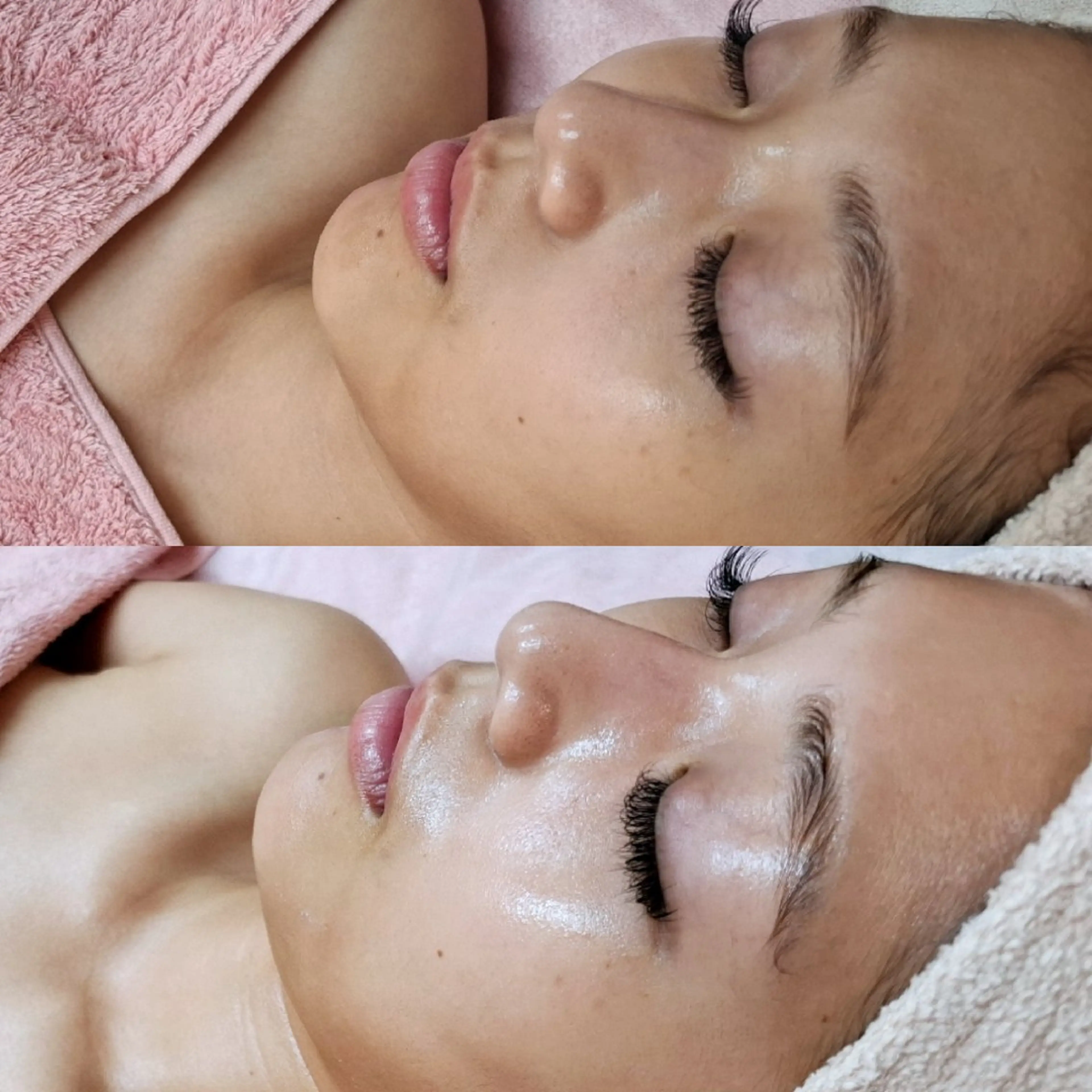 《12月前半キャンペーン》毛穴レス！ララピール+アンプル導入+LED】ニキビケア・毛穴撲滅・ツヤ肌✨️の写真