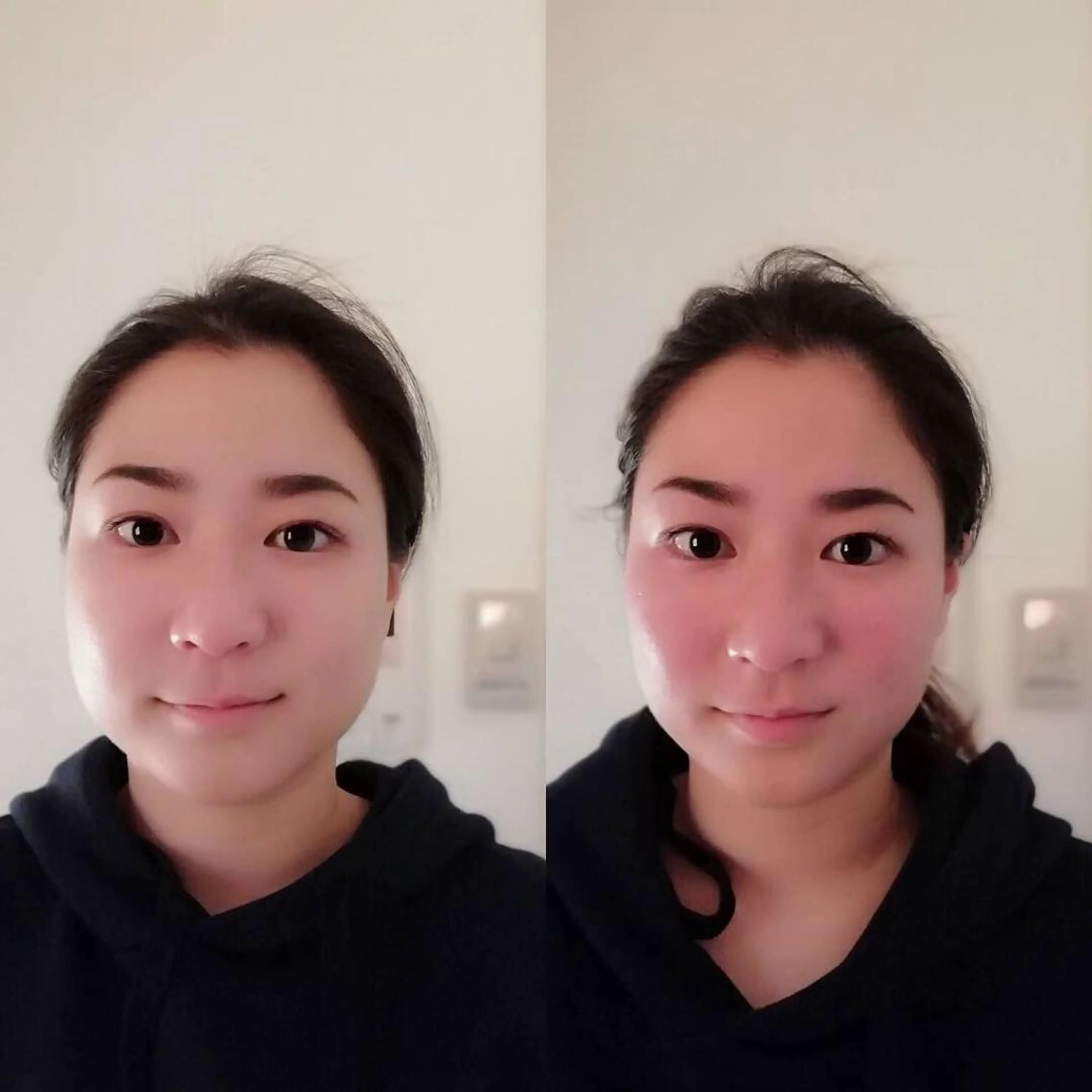 【人気No.１👑】小顔になれる美容鍼《プレミアム美顔コース》▷美顔鍼100本（パルス付）▷姿勢矯正▷美顔矯正▷小顔調整の写真