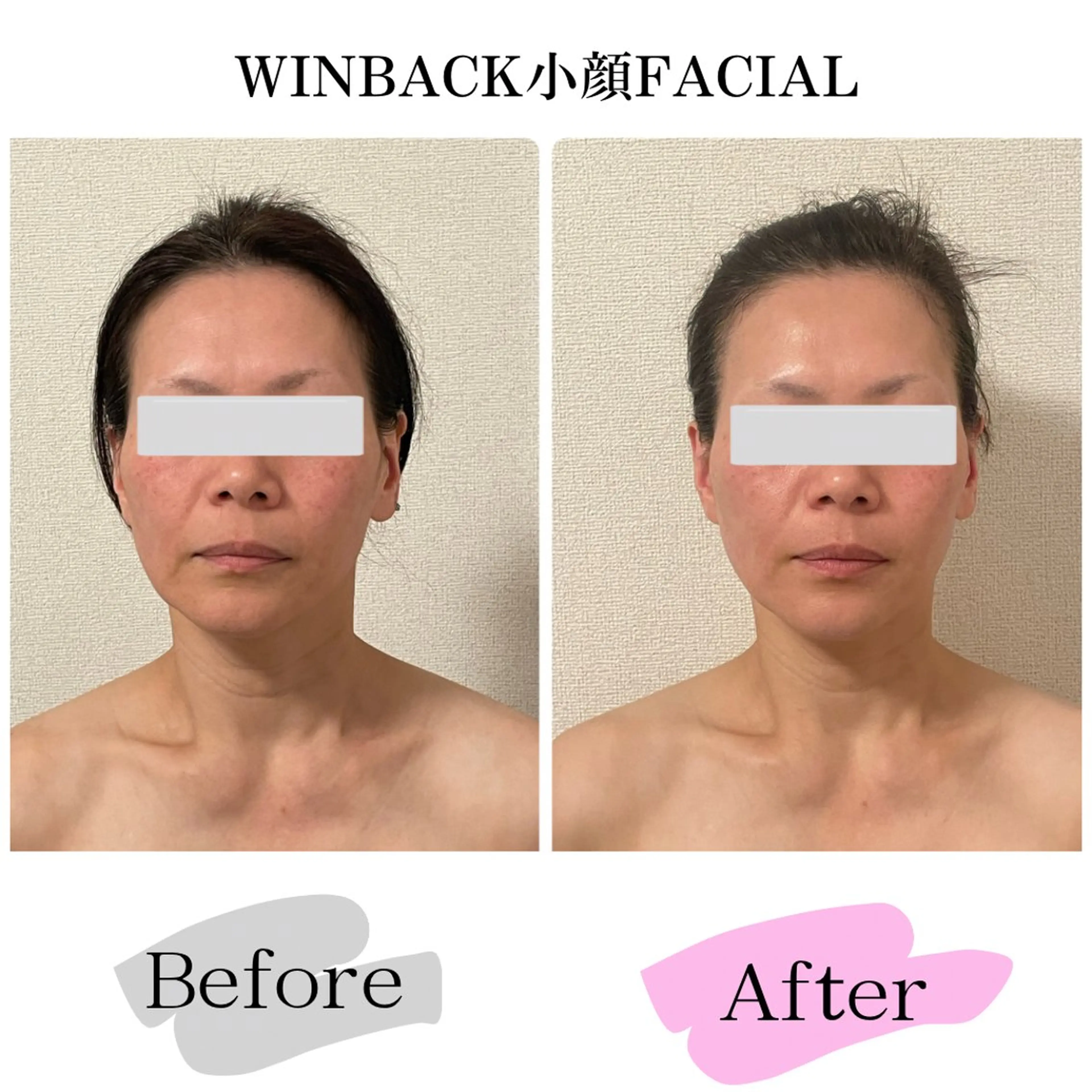 40代からのお客様に圧倒的人気👑１回の効果が絶大リフトアップ&小顔術🩷WINBACKオールハンドフェイシャル80分の写真