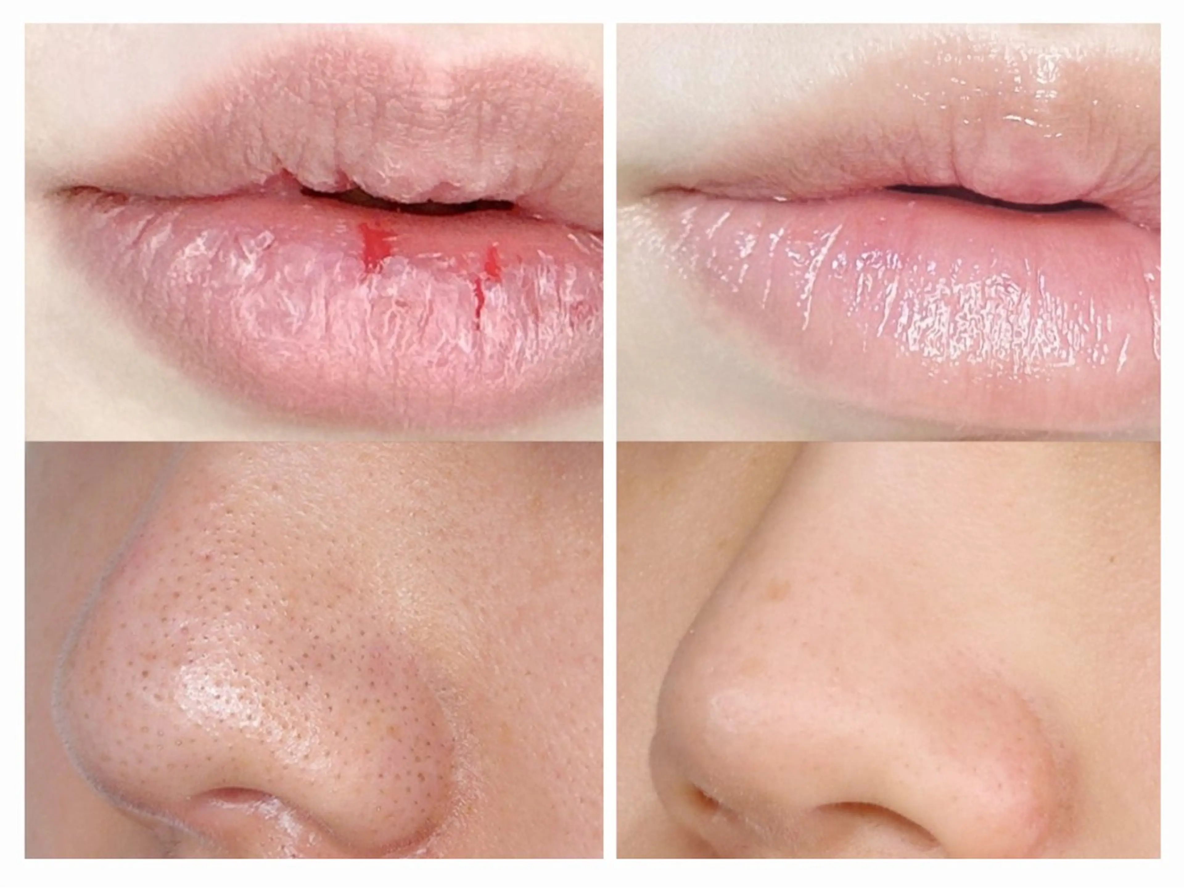 23Khz超音波(イチゴ鼻の黒ずみ撃退 &毛穴洗浄 &ぷるぷる唇)の写真