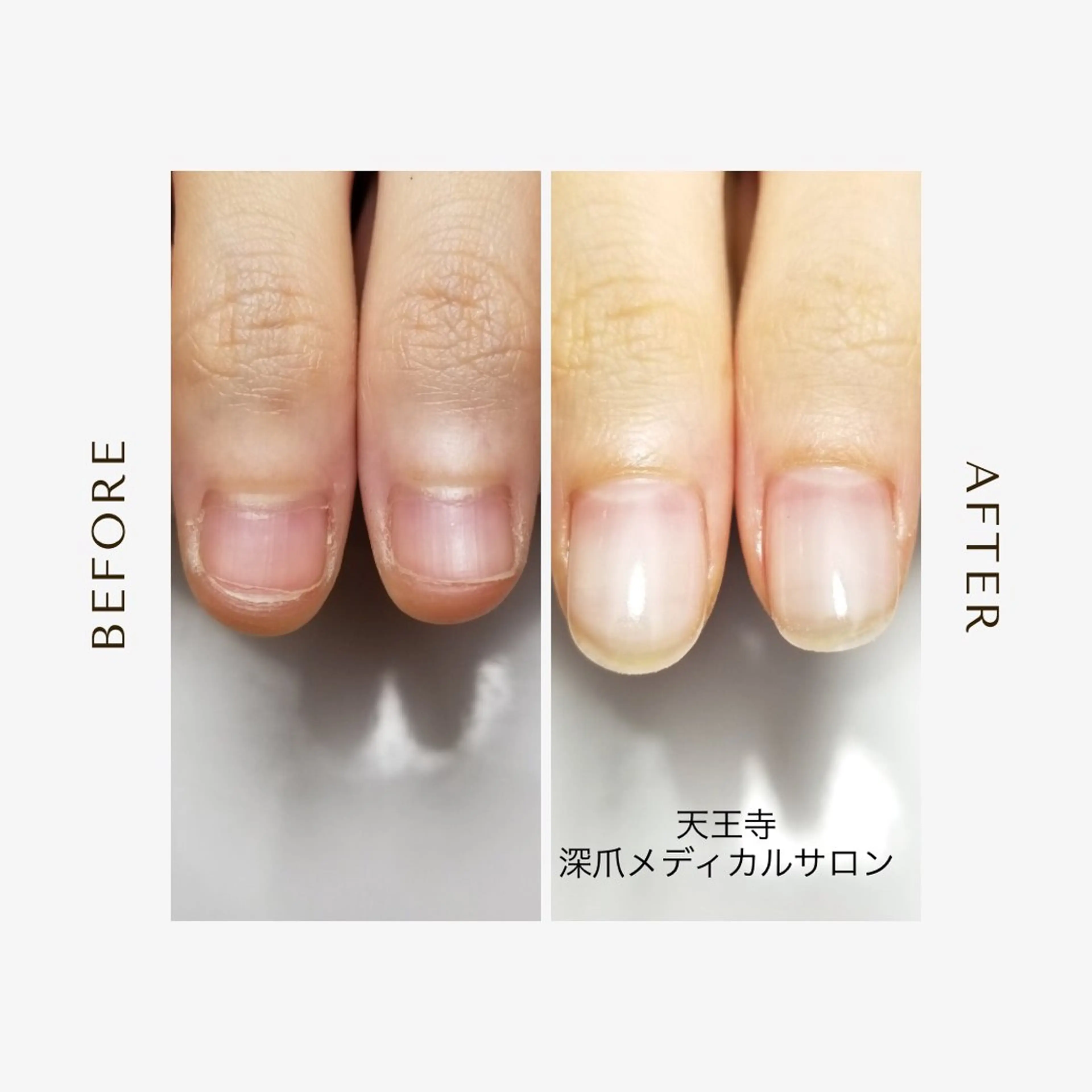 ネイル 天王寺 深爪メディカルサロンのネイルデザイン