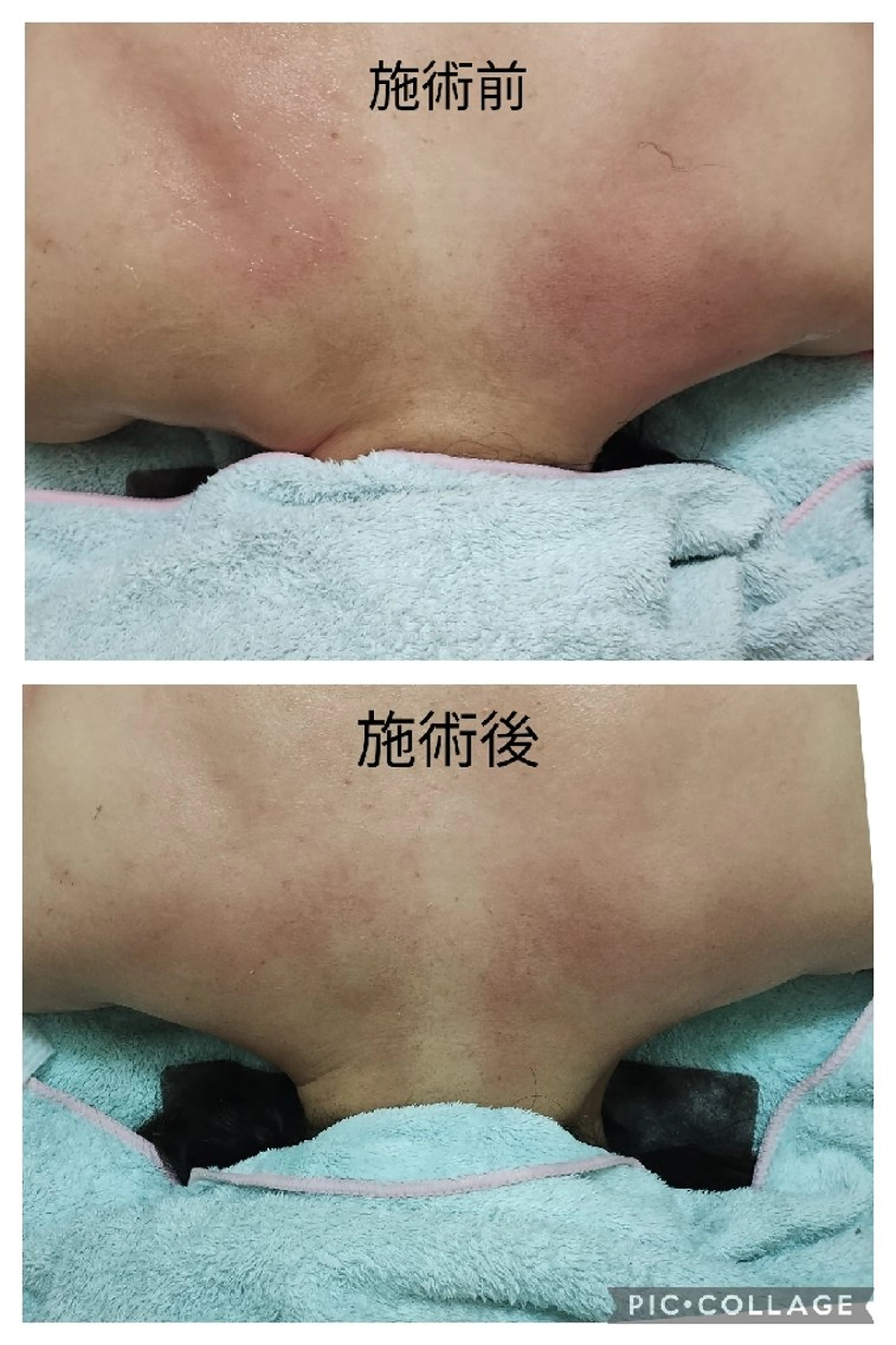 背面マッサージ✨️筋膜の癒着を解消★】首、肩、肩甲骨コリ・温感筋膜リリースの写真