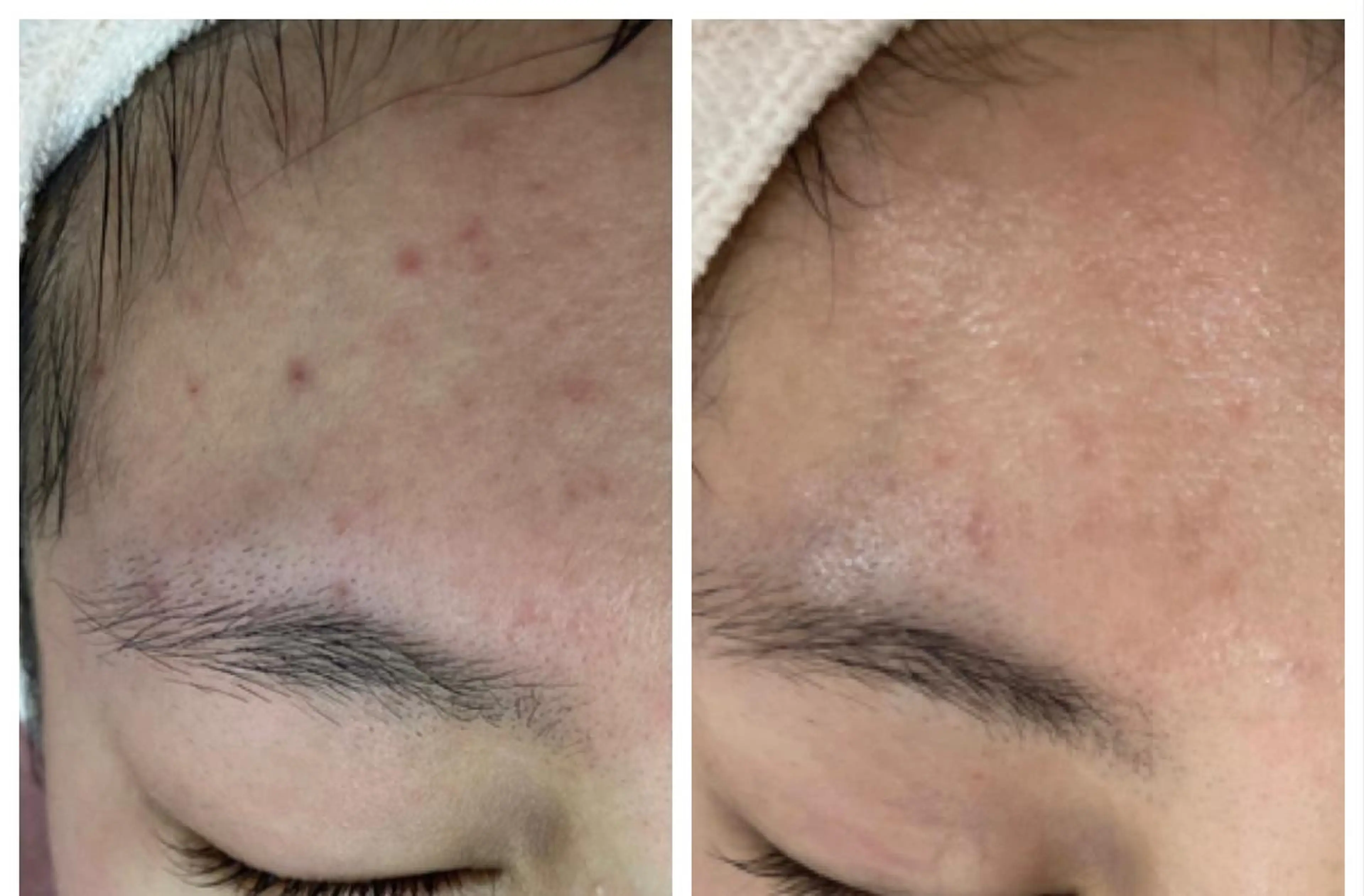 【ニキビ肌】お悩み別の肌質改善&メイクで至福の90分。初回のみ120分。通常¥7700→¥4500ミニモ特別価格です☺️の写真