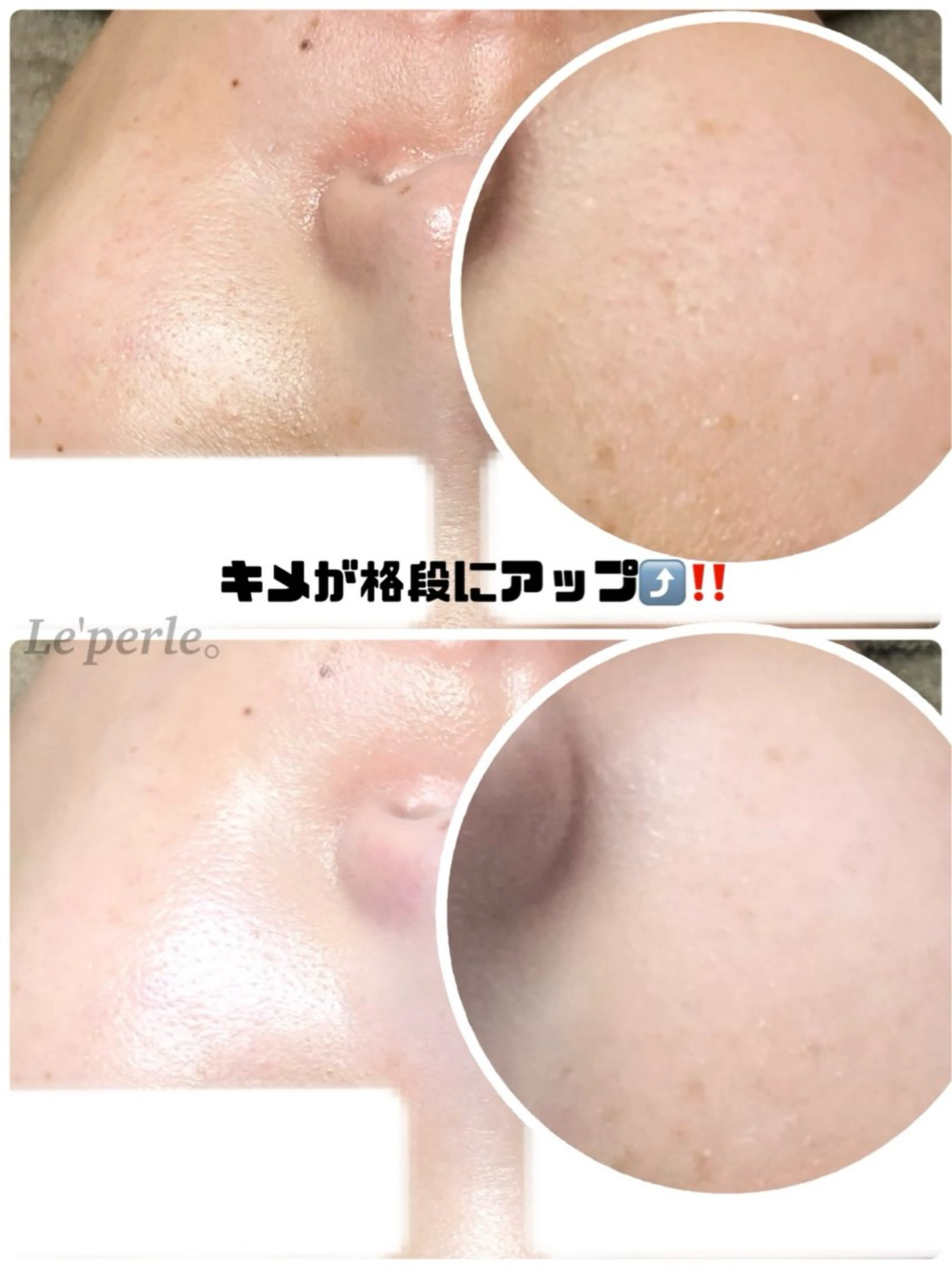 毛穴エクストラクション✖️ハーブピーリングで最強美肌☆モニター様募集☆の写真