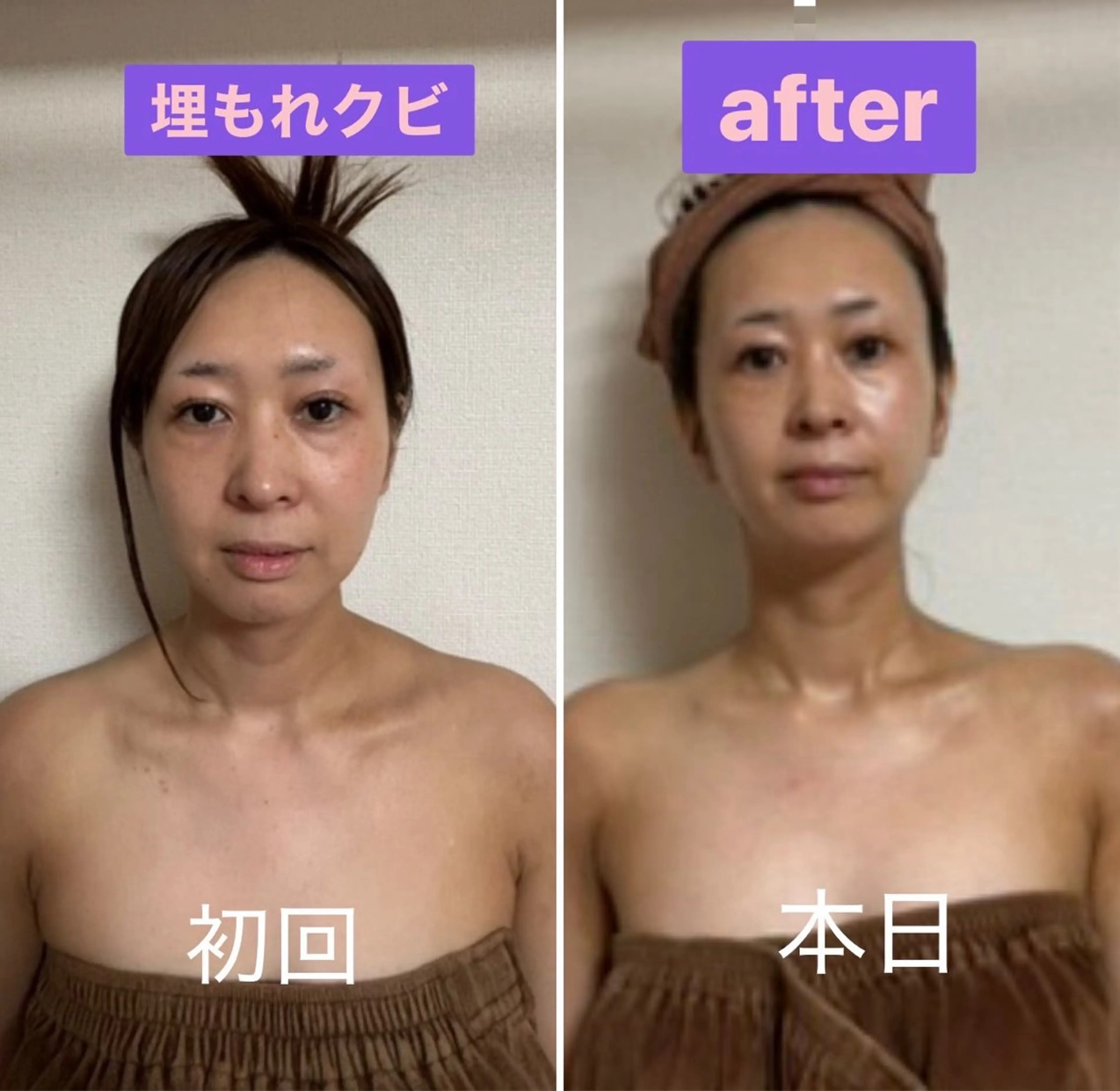 💛デコルテ&クビ&背中aromaマッサージ💛ラジオ波の温熱効果で血管拡張固まった上半身「あっためて血流アップ」の写真