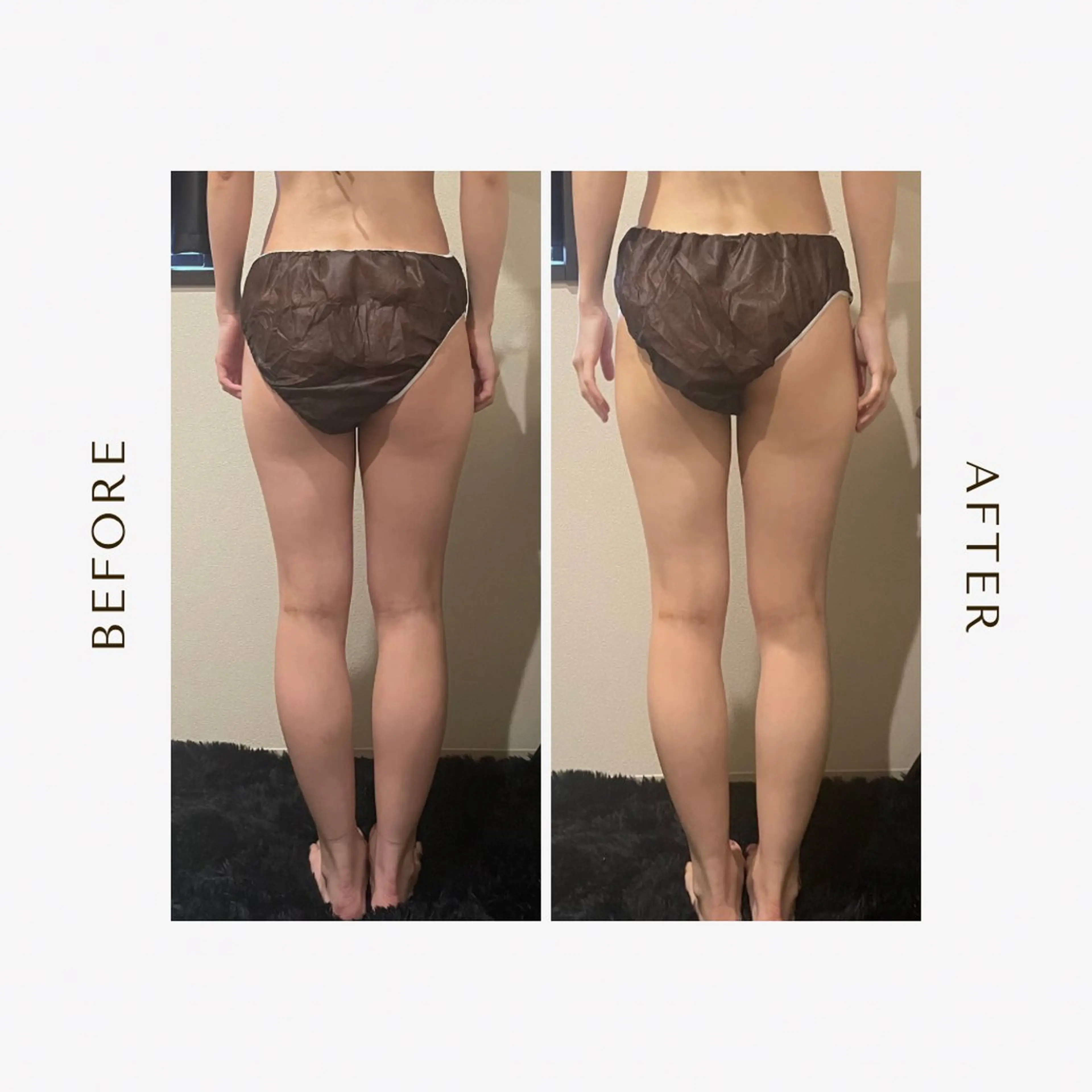 🦵🔥脚スリム集中プラン（痩身マシーン✕リンパ）の写真