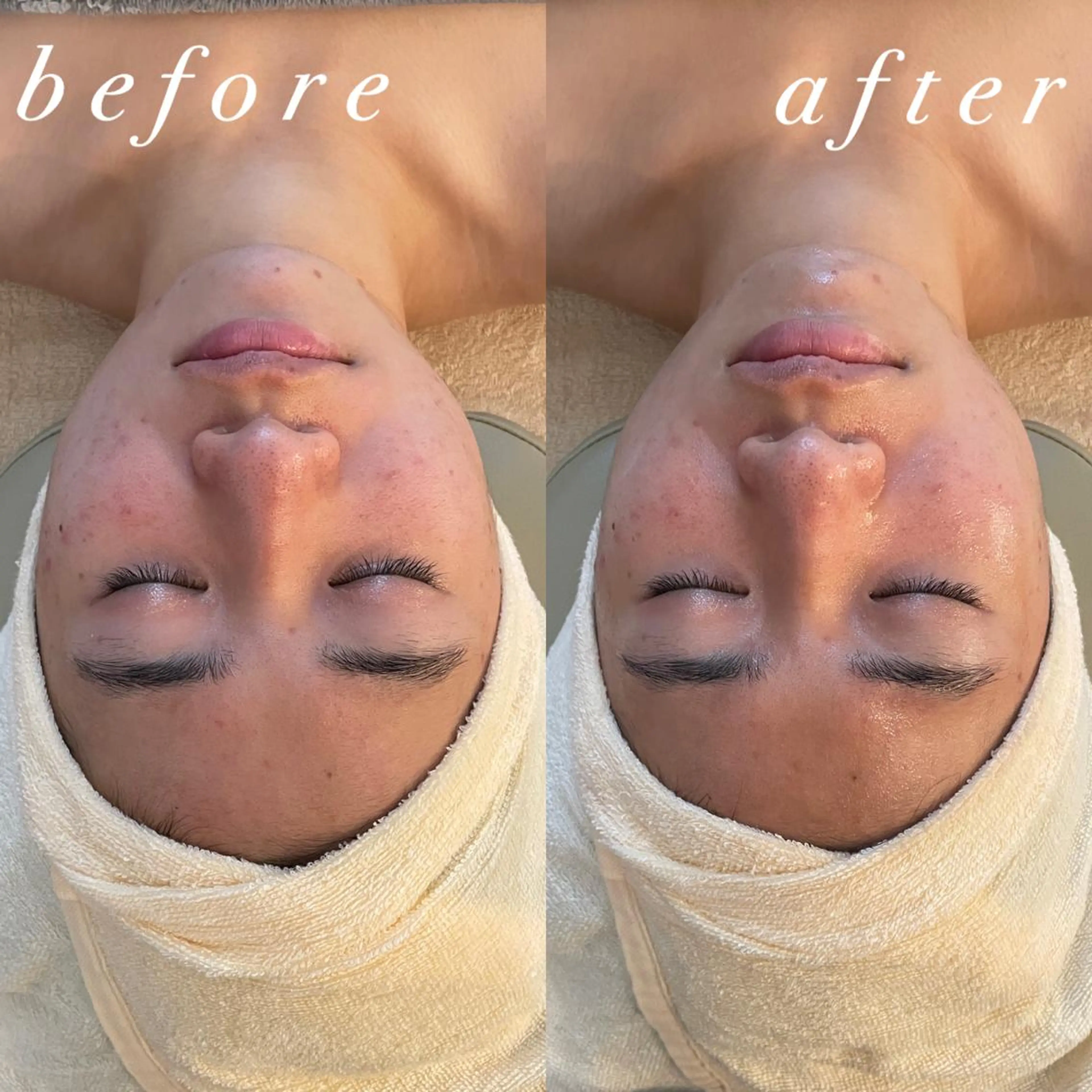 うなじ脱毛/美肌脱毛 LABELのエステ・リラクイメージ