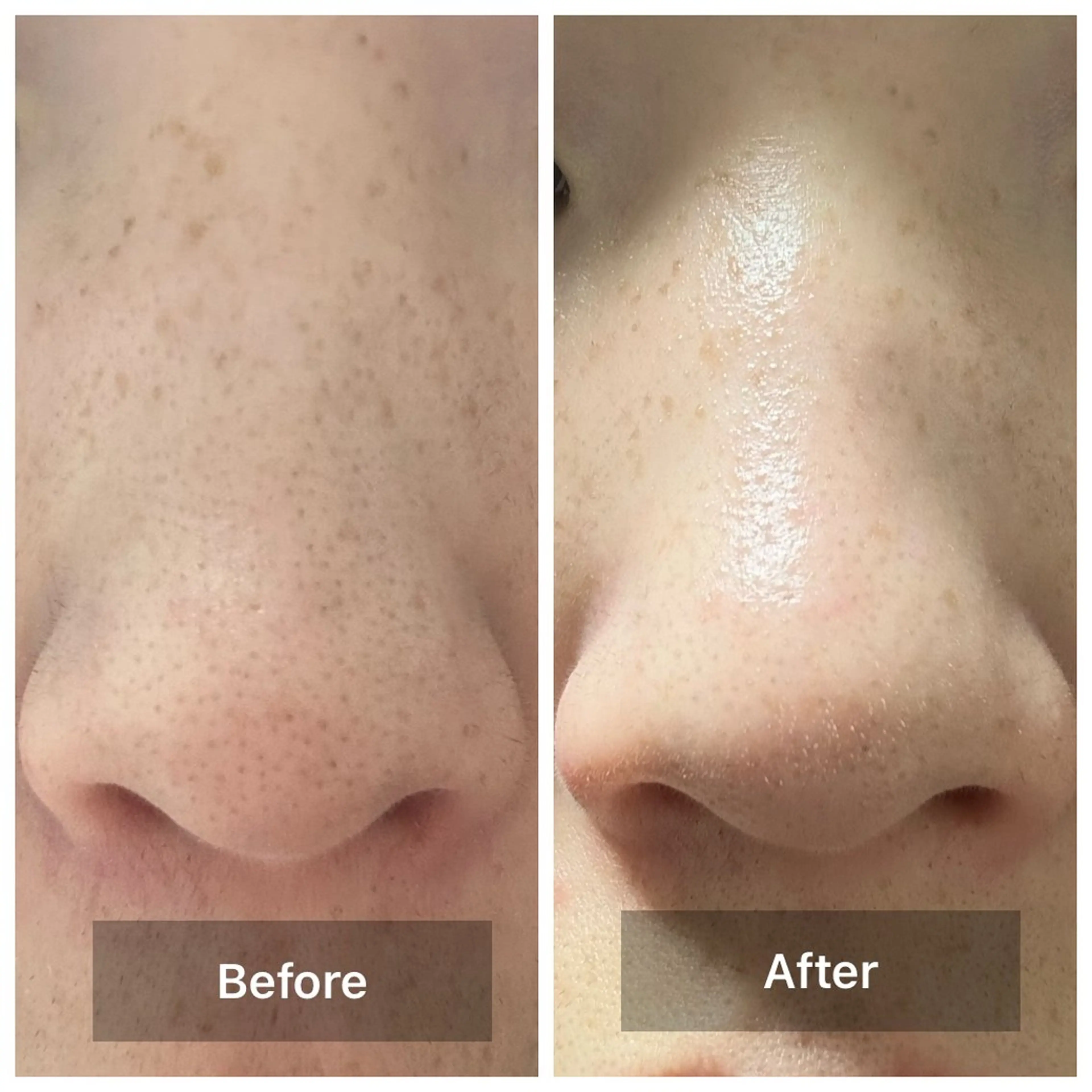 【ご新規様限定】小鼻集中エステ~毛穴レスなお肌に~の写真