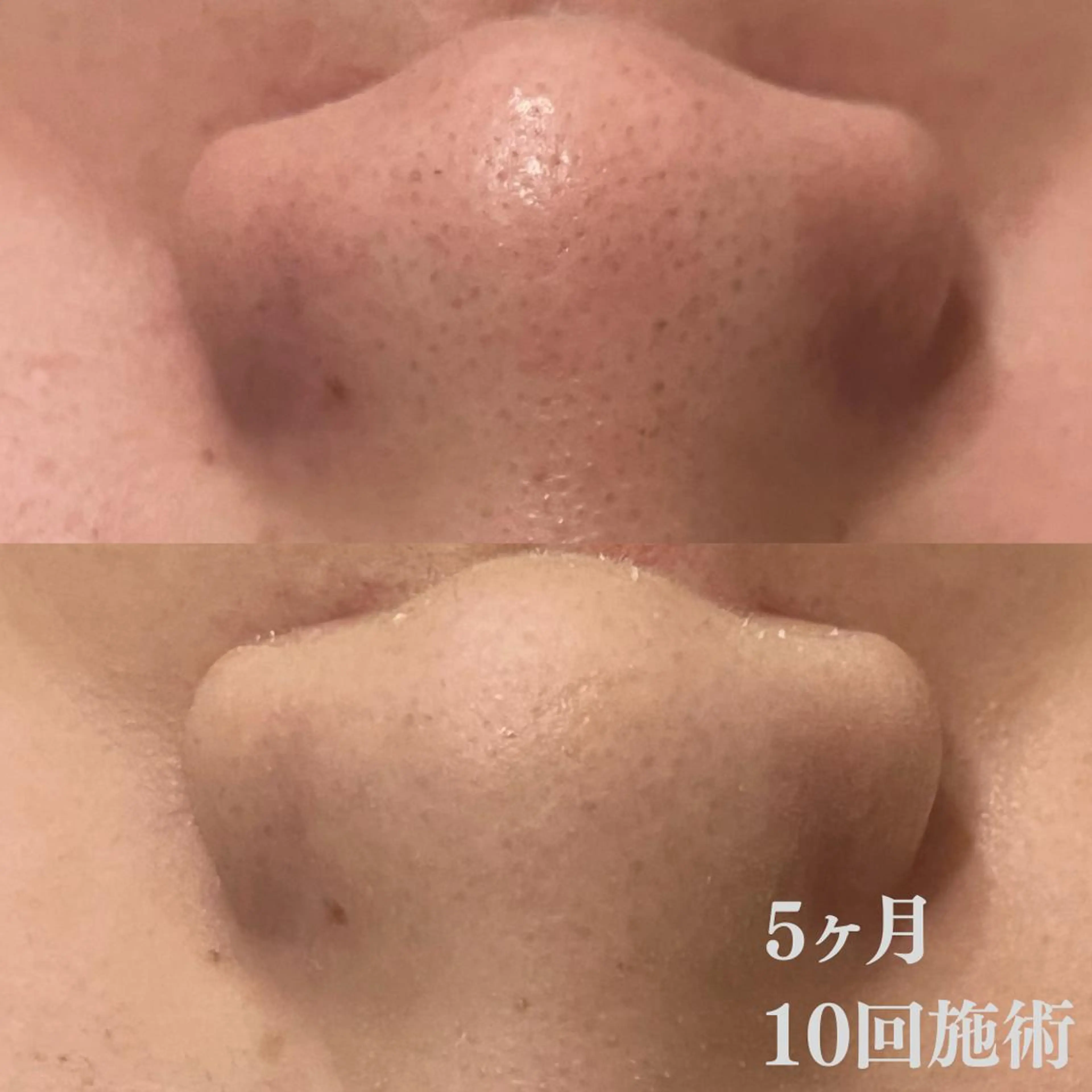 学生ニキビ改善🍀 優しい肌質改善のエステ・リラクイメージ