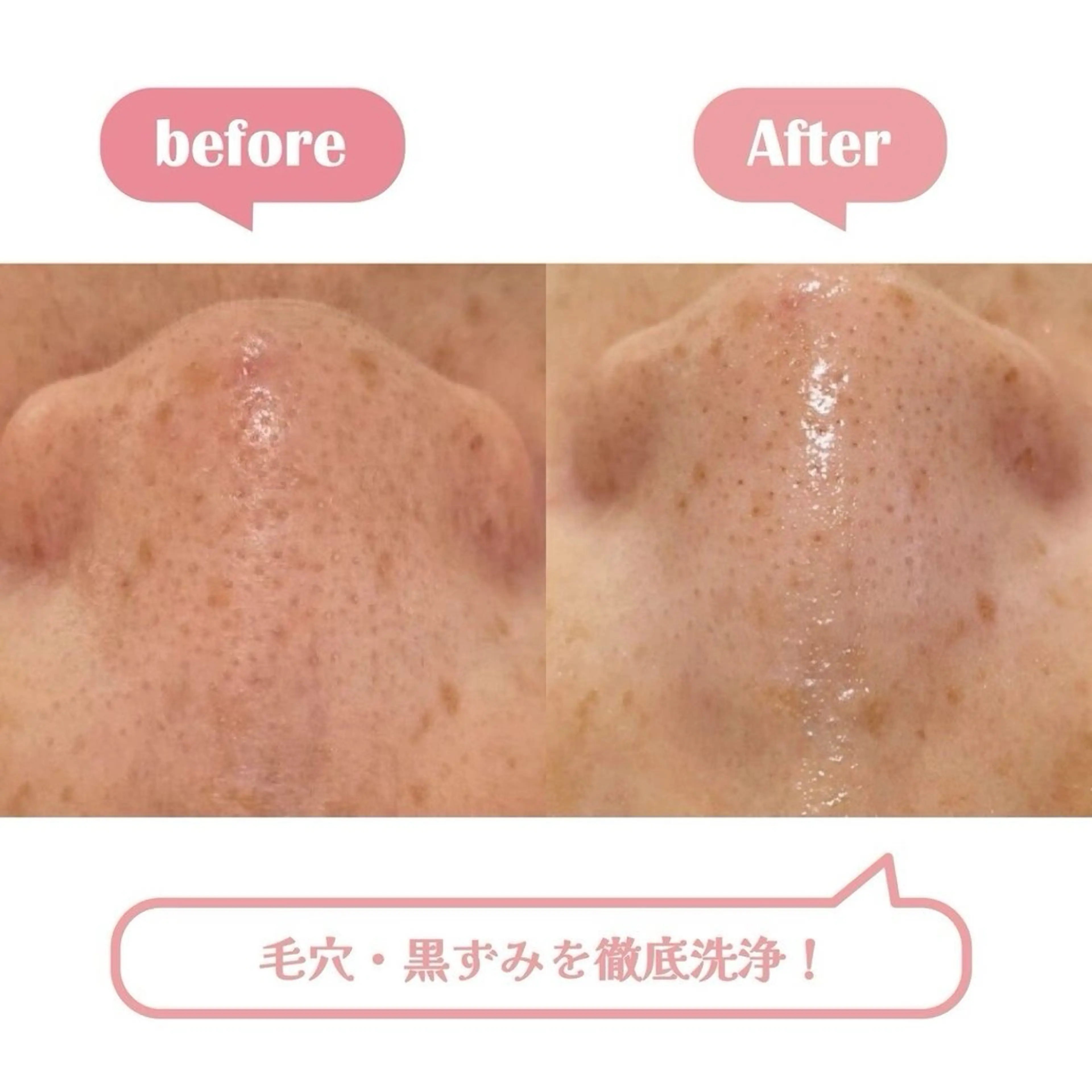 ざらつき・毛穴汚れ解消コースの写真