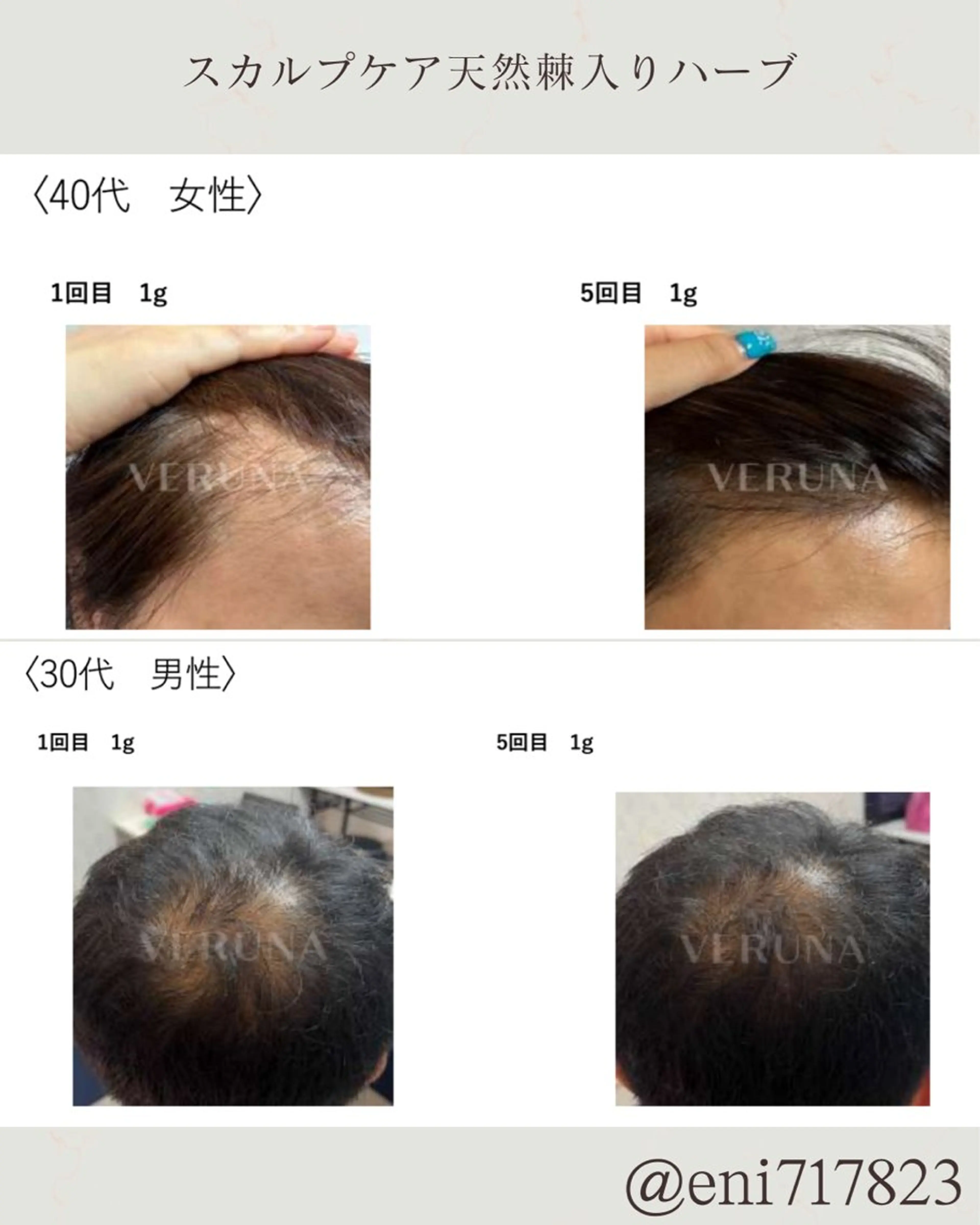 新店に向けた特別モニター4回💆‍♀️天然棘スカルプケア💆‍♂️生え際or1箇所｜ドライヘッドスパ含む贅沢施術4種類付の写真