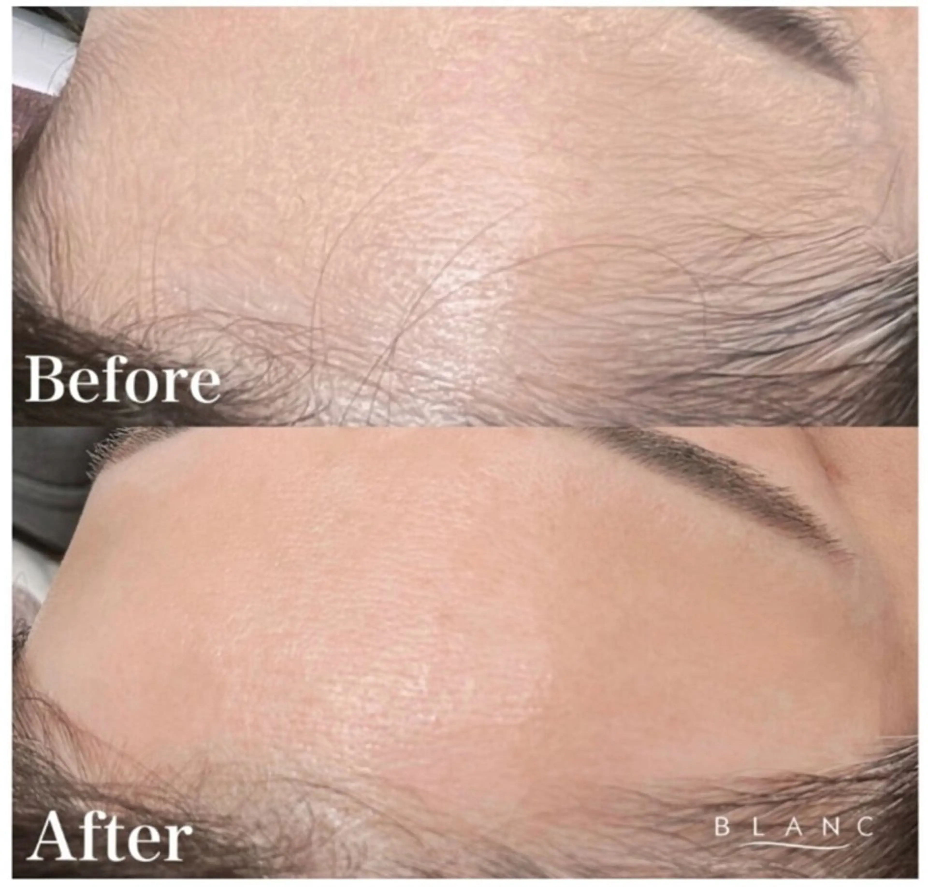 【無料🎀】8/6 13:00​〜​ つるん✨️おでこWAXの写真