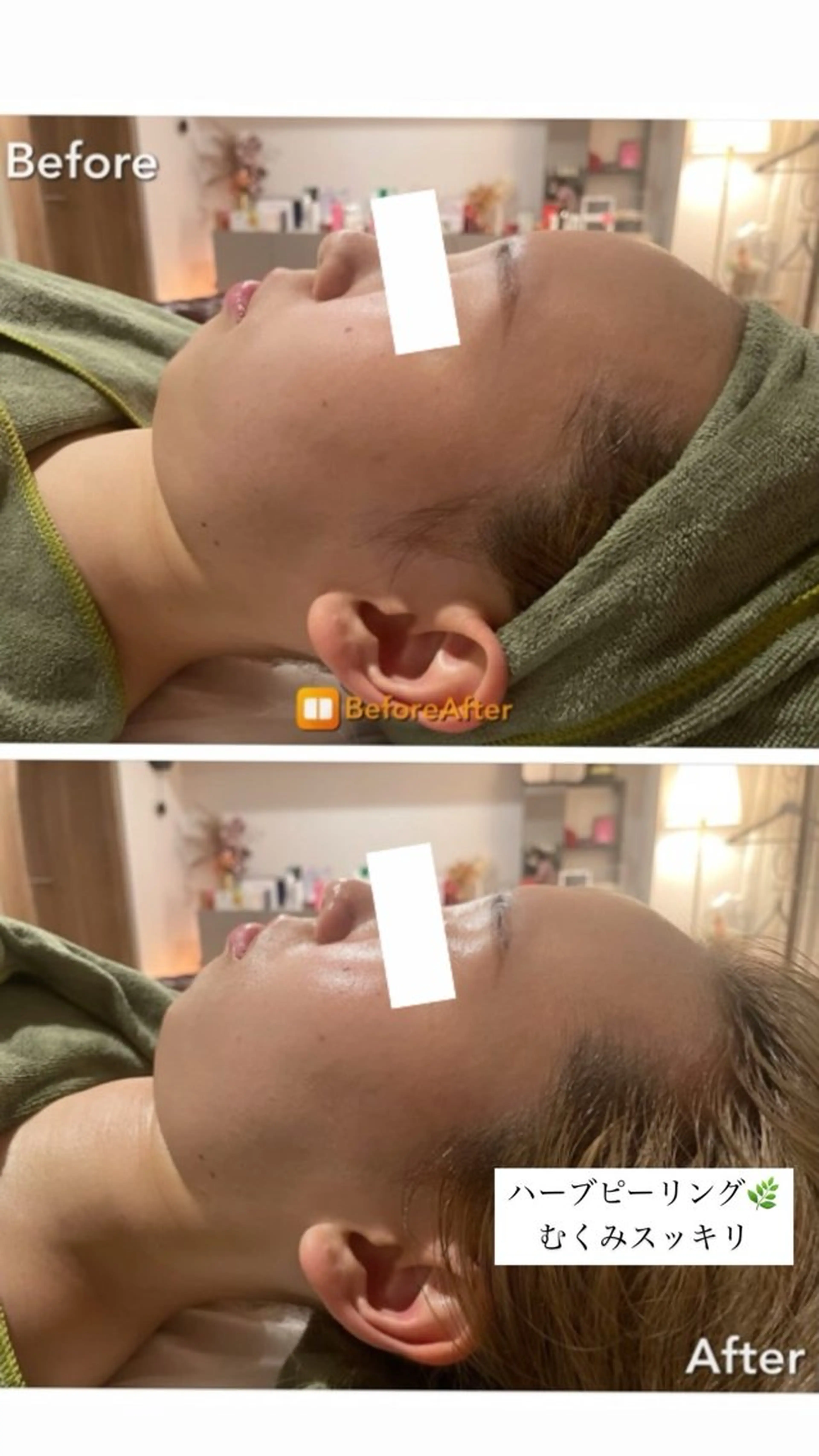 エステ Meupニキビ専門店 背中/ハーブ/肌管理のその他イメージ