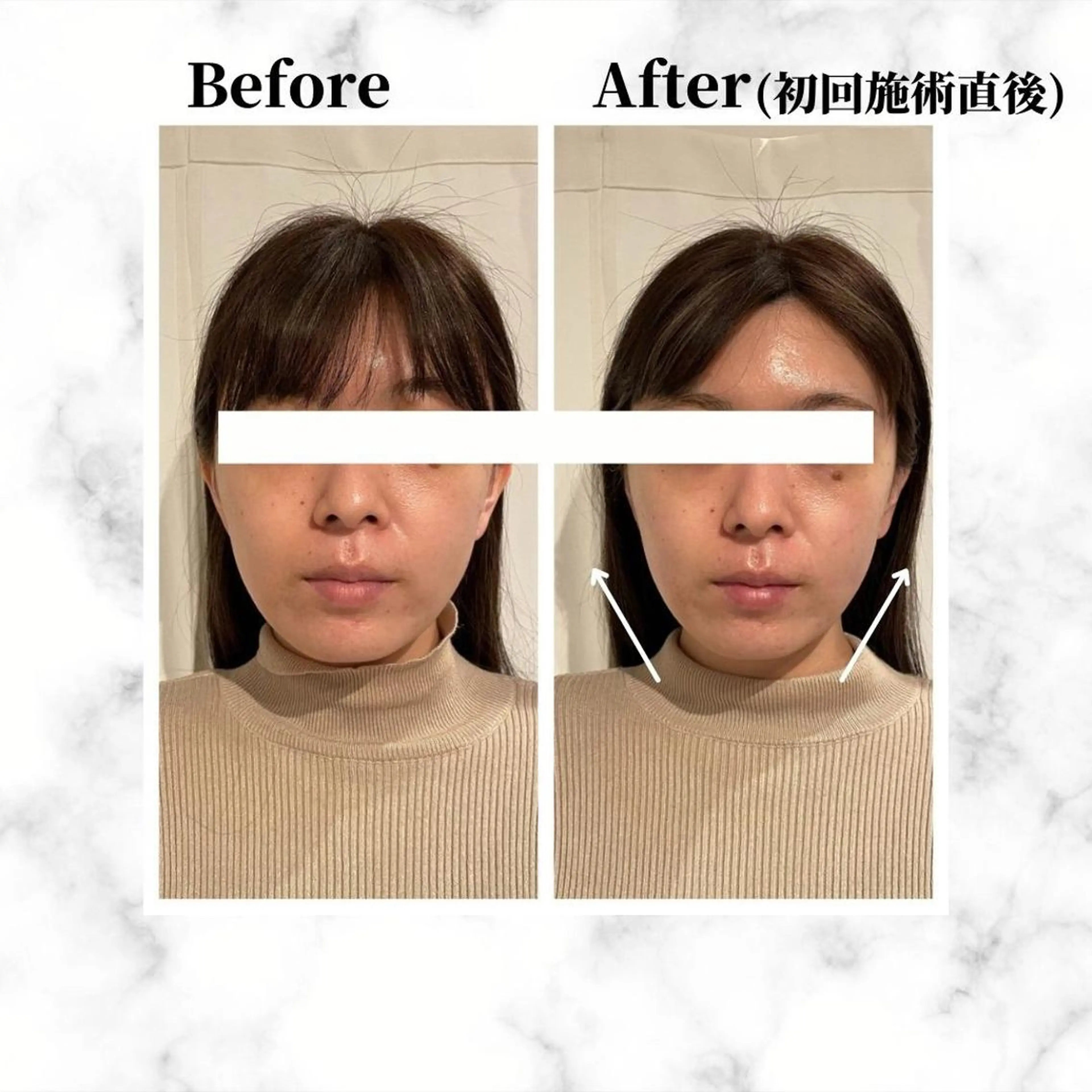 エステ リラク 12Dハイフ💗 最強小顔のエステ・リラクイメージ