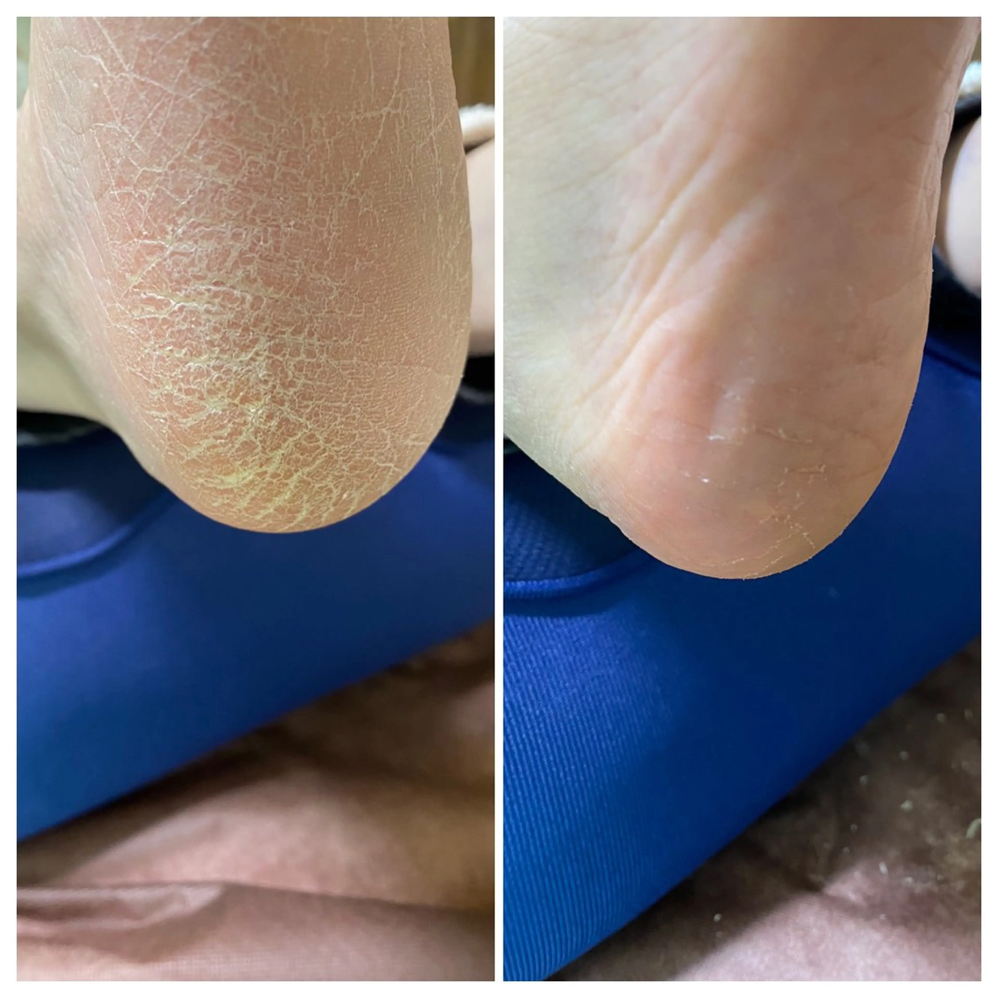 かかと角質ケアうるうるパック付60分 座ってるだけでうるうるかかとに!の写真