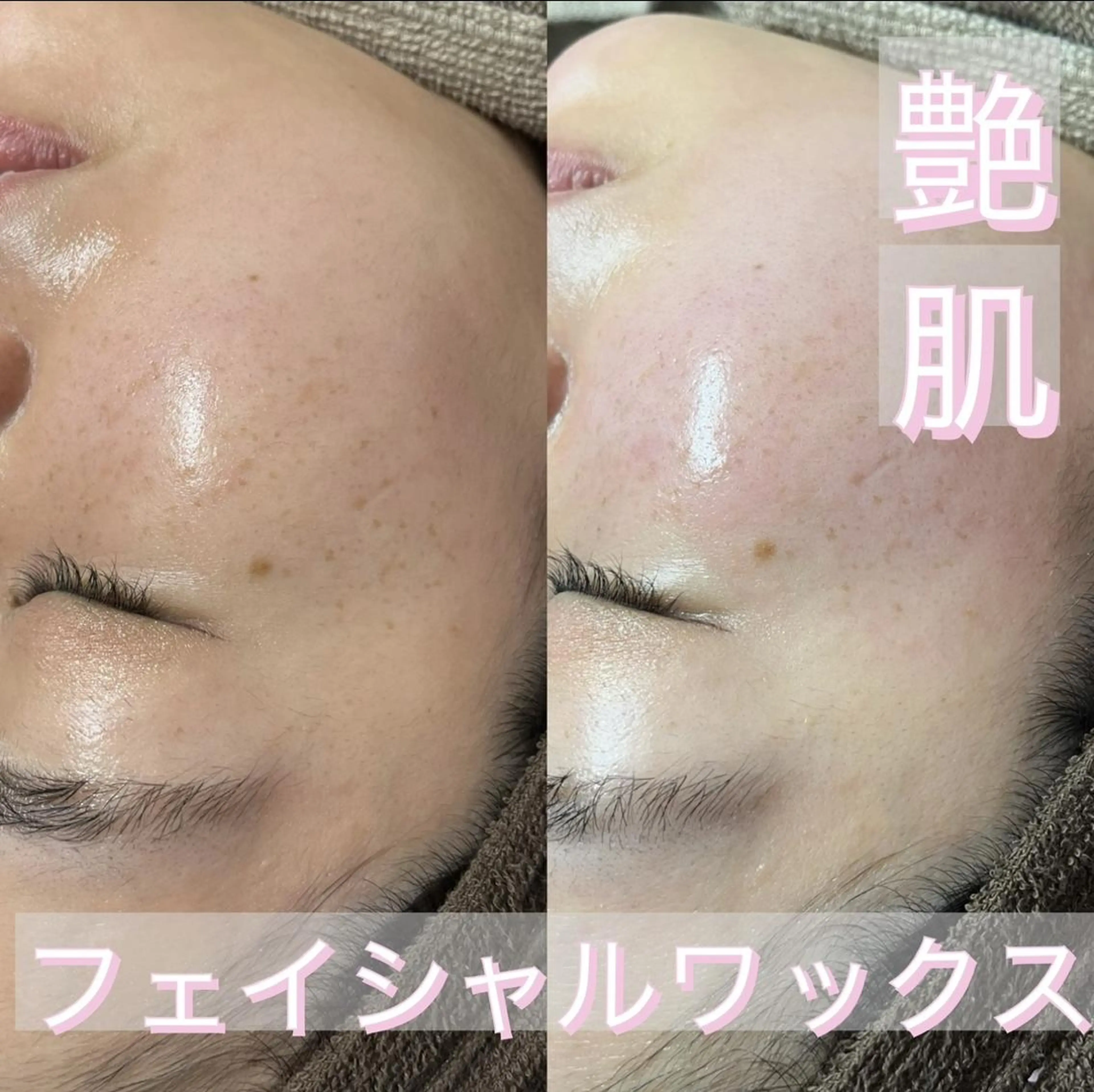 フェイシャルワックス+鎮静パック🚹🚺の写真