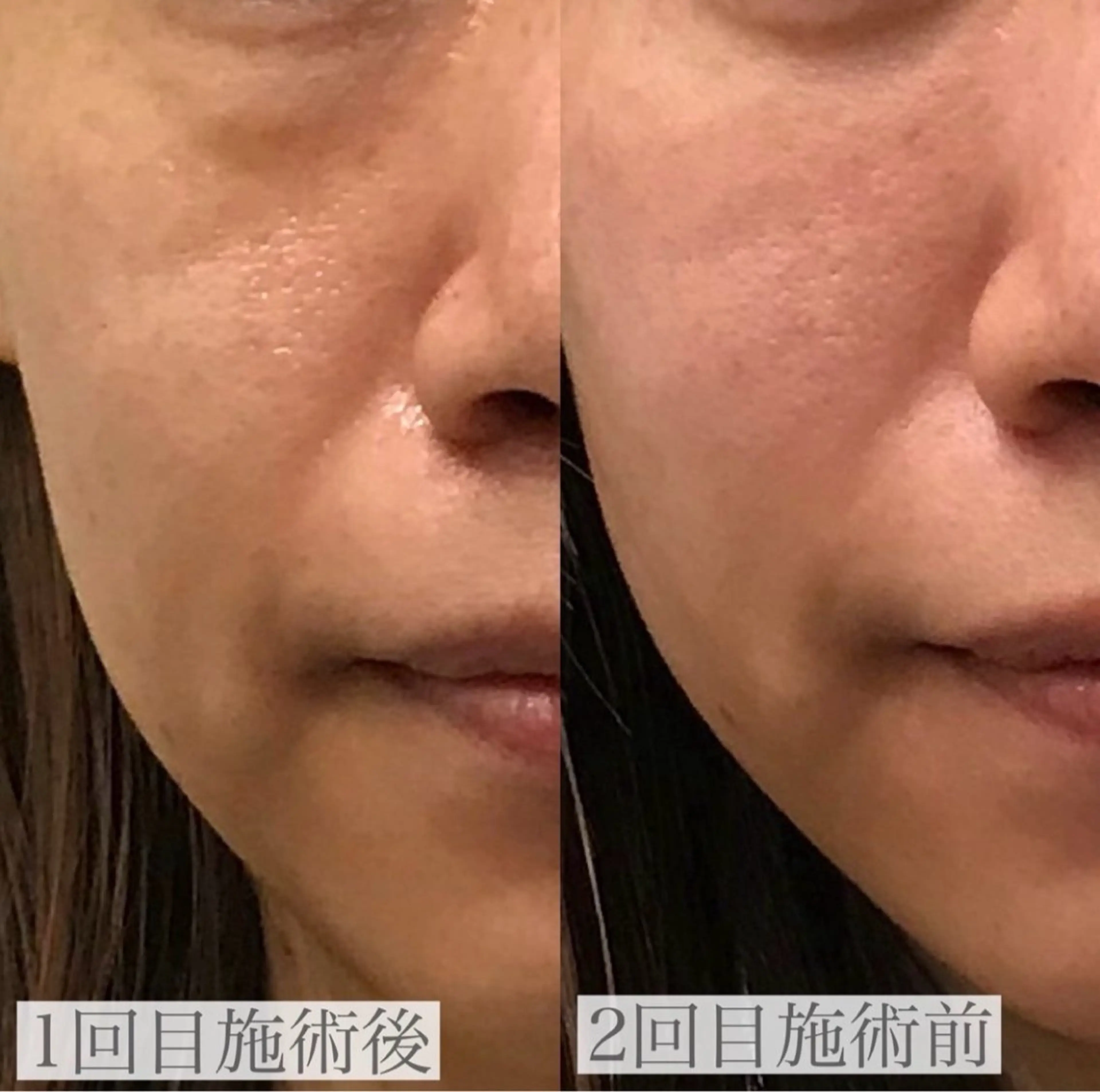 エステ EARTH coiffure beaute 新潟紫竹山店所属・🤍アベシュリ /フェイシャル🤍のエステ・リラクイメージ