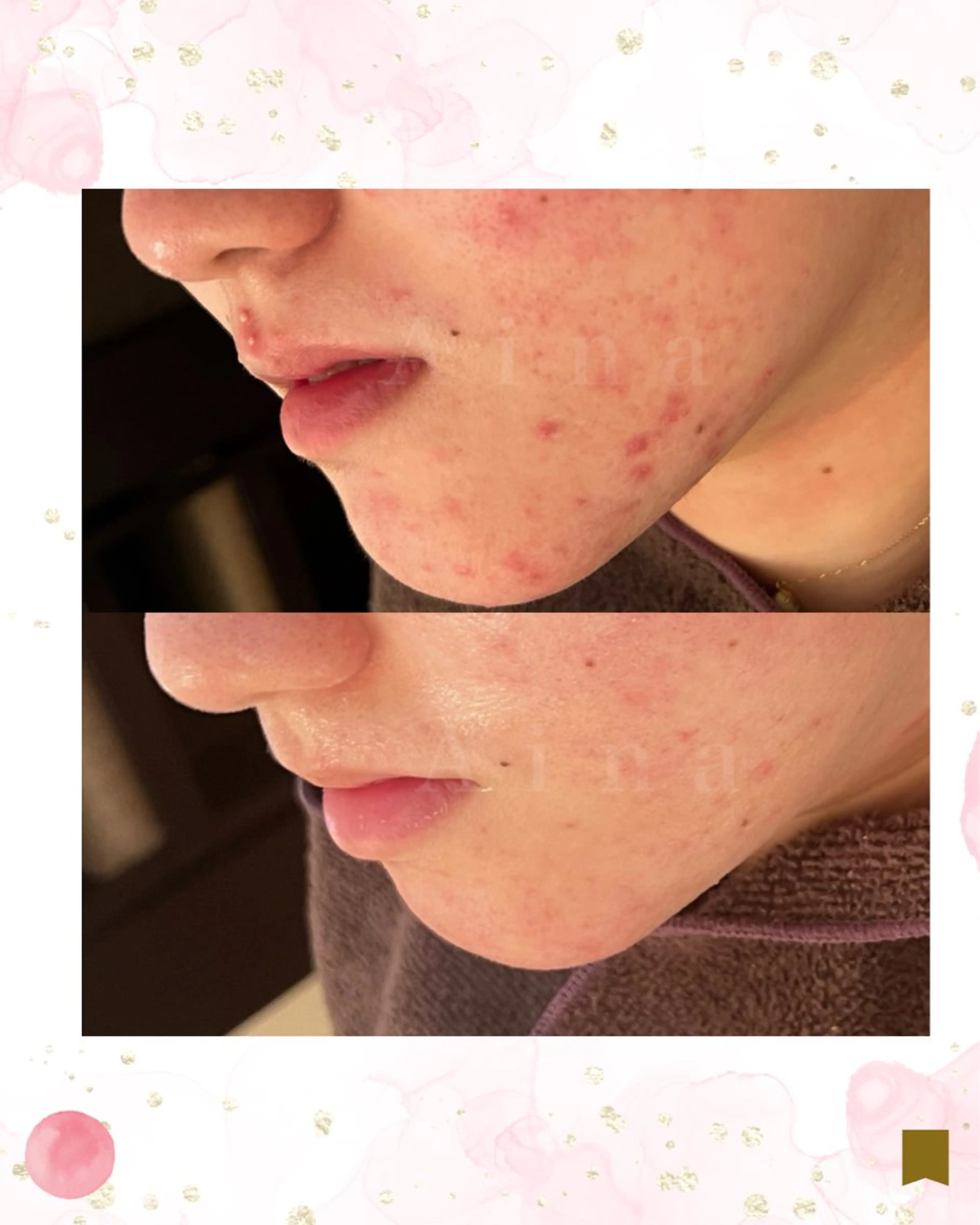 ニキビ跡専門サロン Ainaのエステ・リラクイメージ