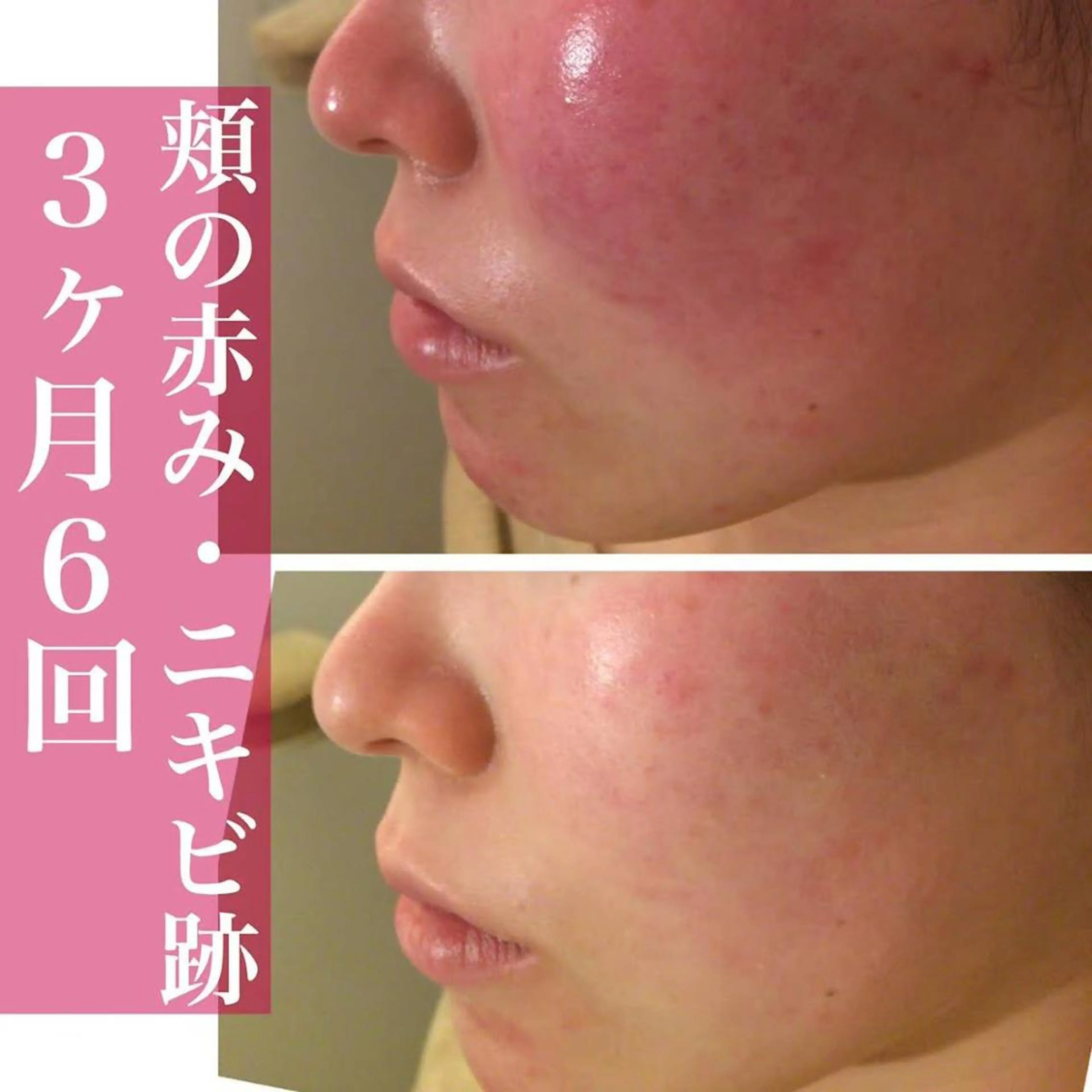 セミロング カラー パーマ ヘアアレンジ メンズ キッズ ネイル マツエク・マツパ 都内で出来る肌管理！ 最短ニキビ改善のエステ・リラクイメージ