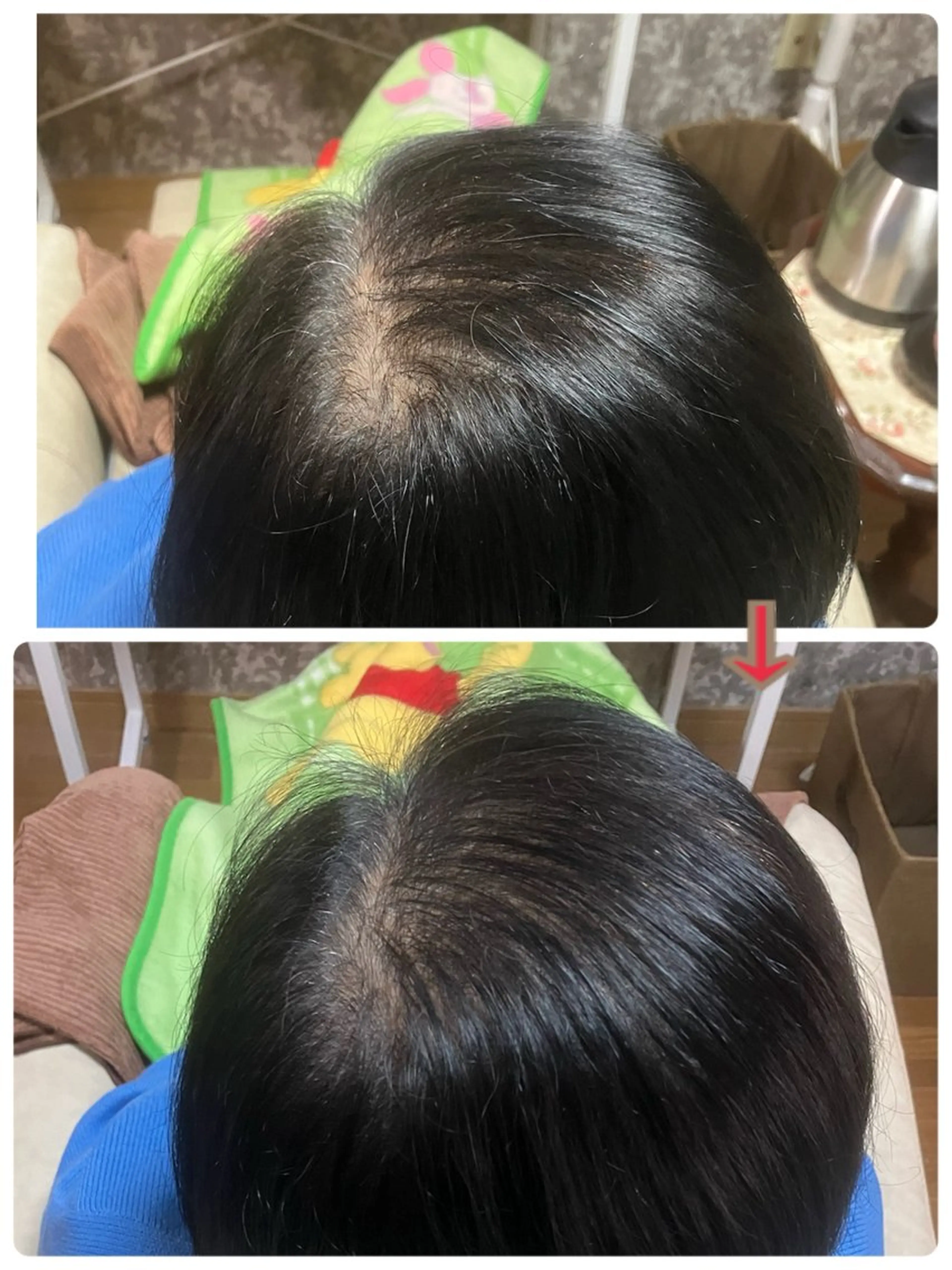 【増毛エクステ】　トップ全体1000本の写真