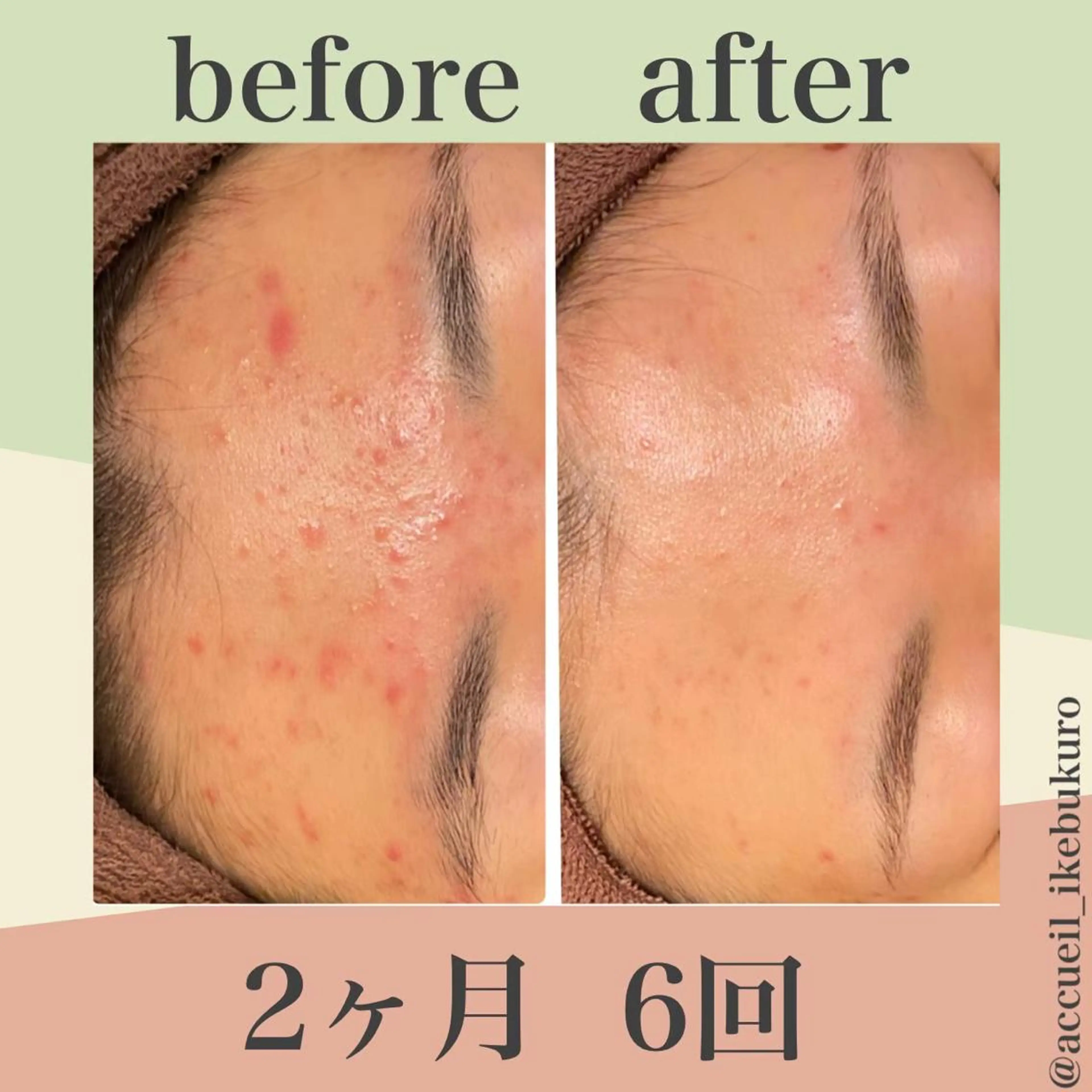 ミディアム カラー パーマ ヘアアレンジ メンズ キッズ ネイル マツエク・マツパ エステ リラク ニキビ・肌質改善専門 ♡人生が変わるサロンのエステ・リラクイメージ