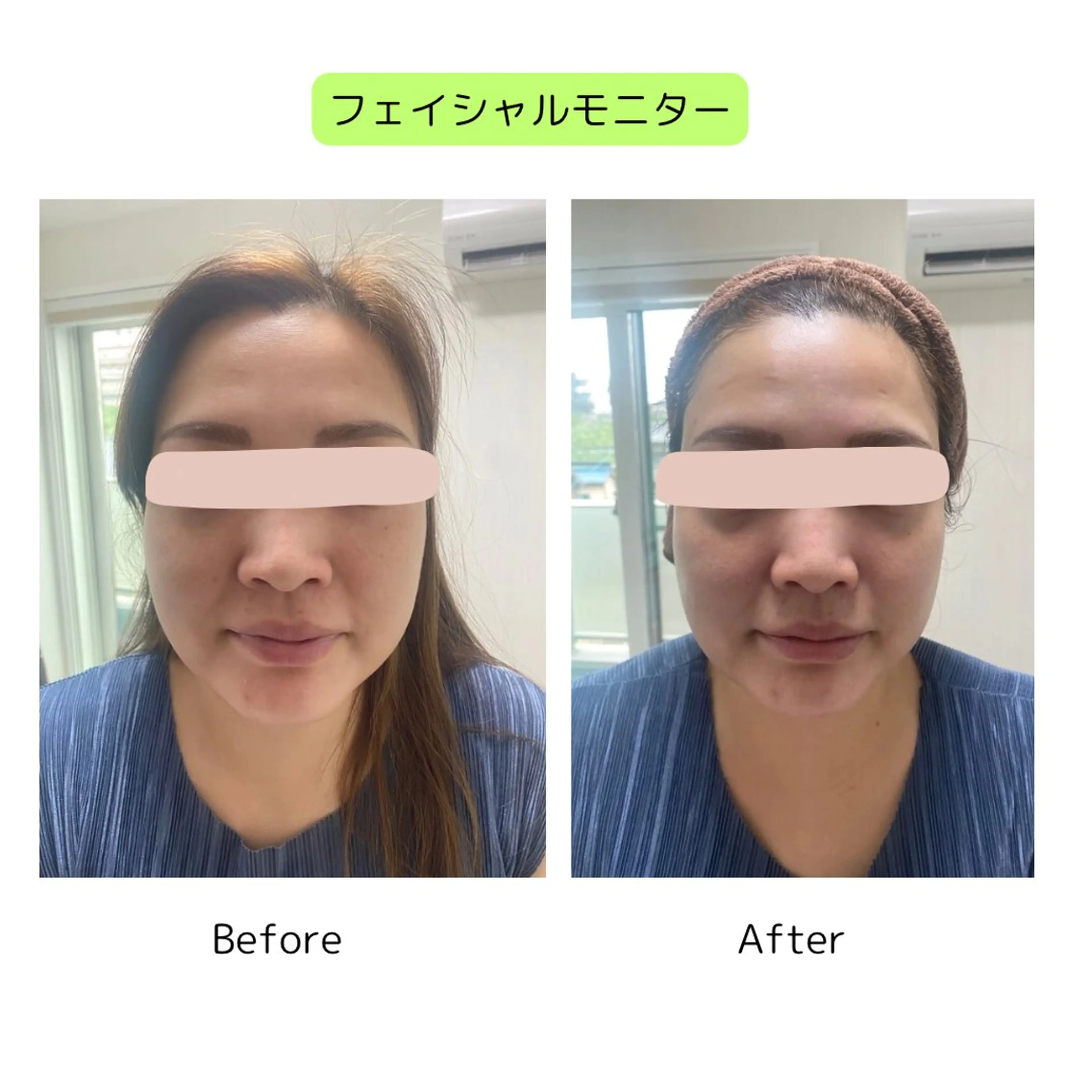 植物性ミネラルで整える小顔フェイシャル＋快楽ヘッドスパ:モニターの写真