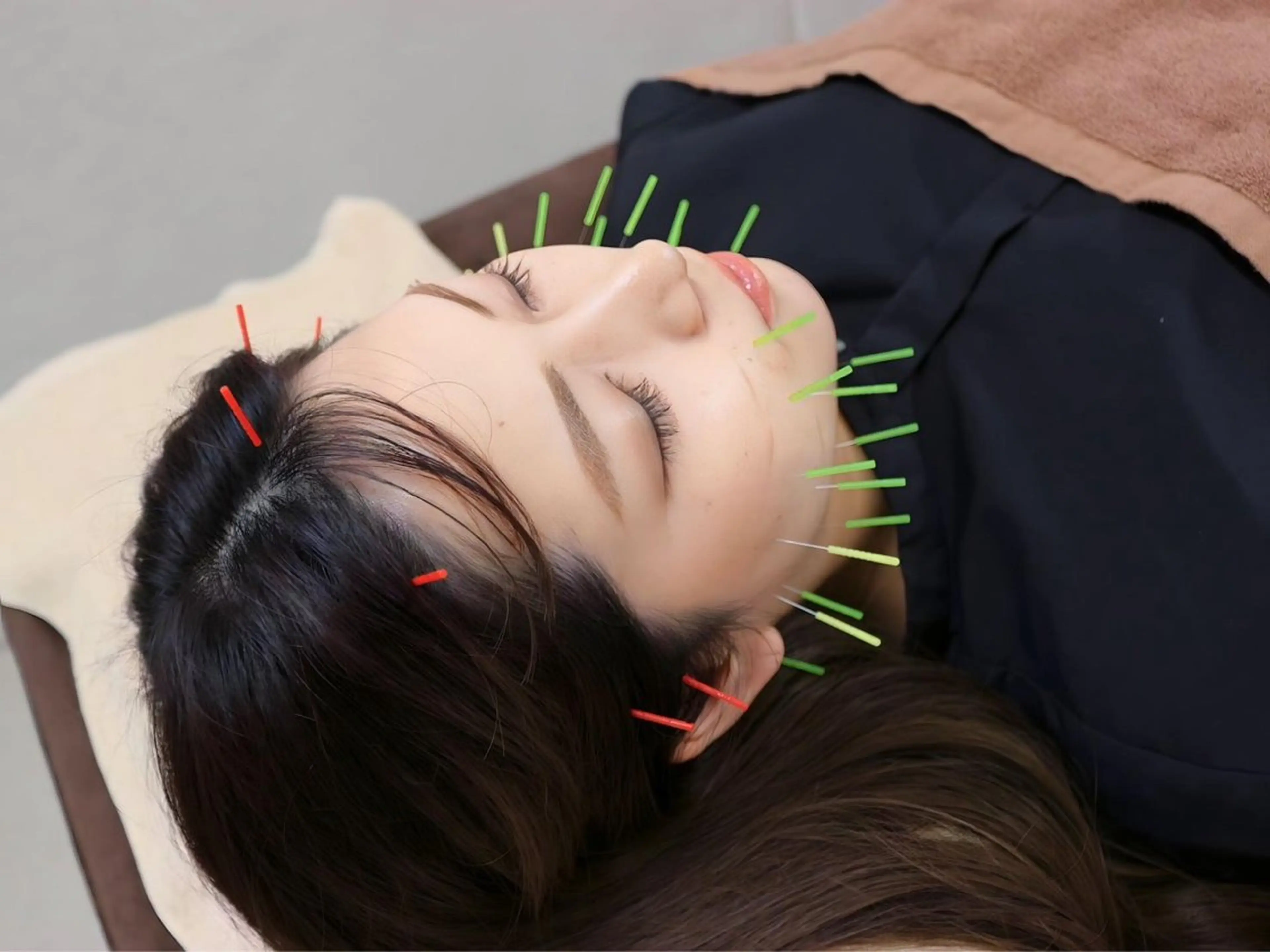 【ご新規様】たるみ・肌質改善🔸美容鍼×小顔矯正🔸お顔集中コース〈45分〉の写真
