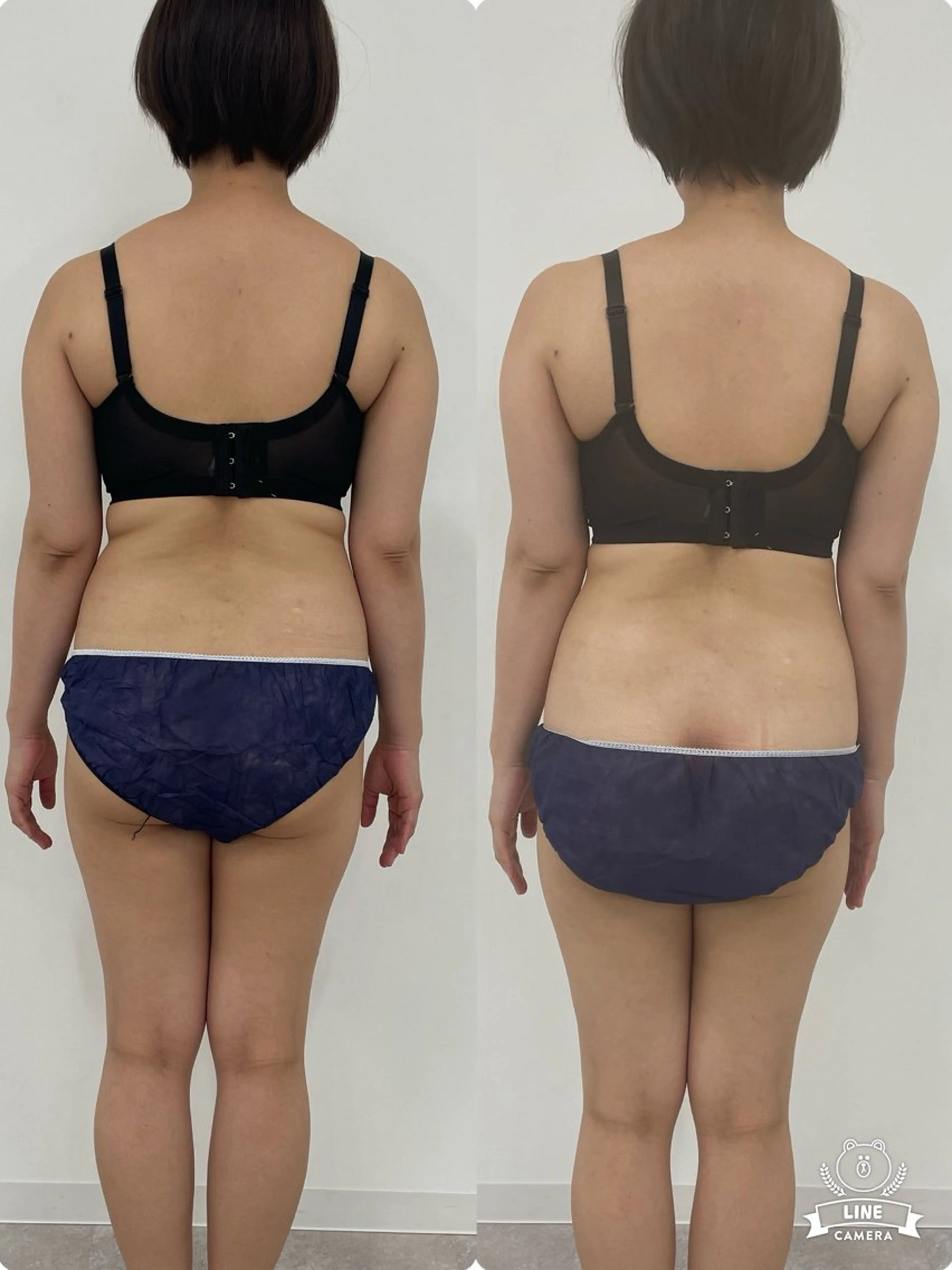 ブライダルエステ上半身コースの写真