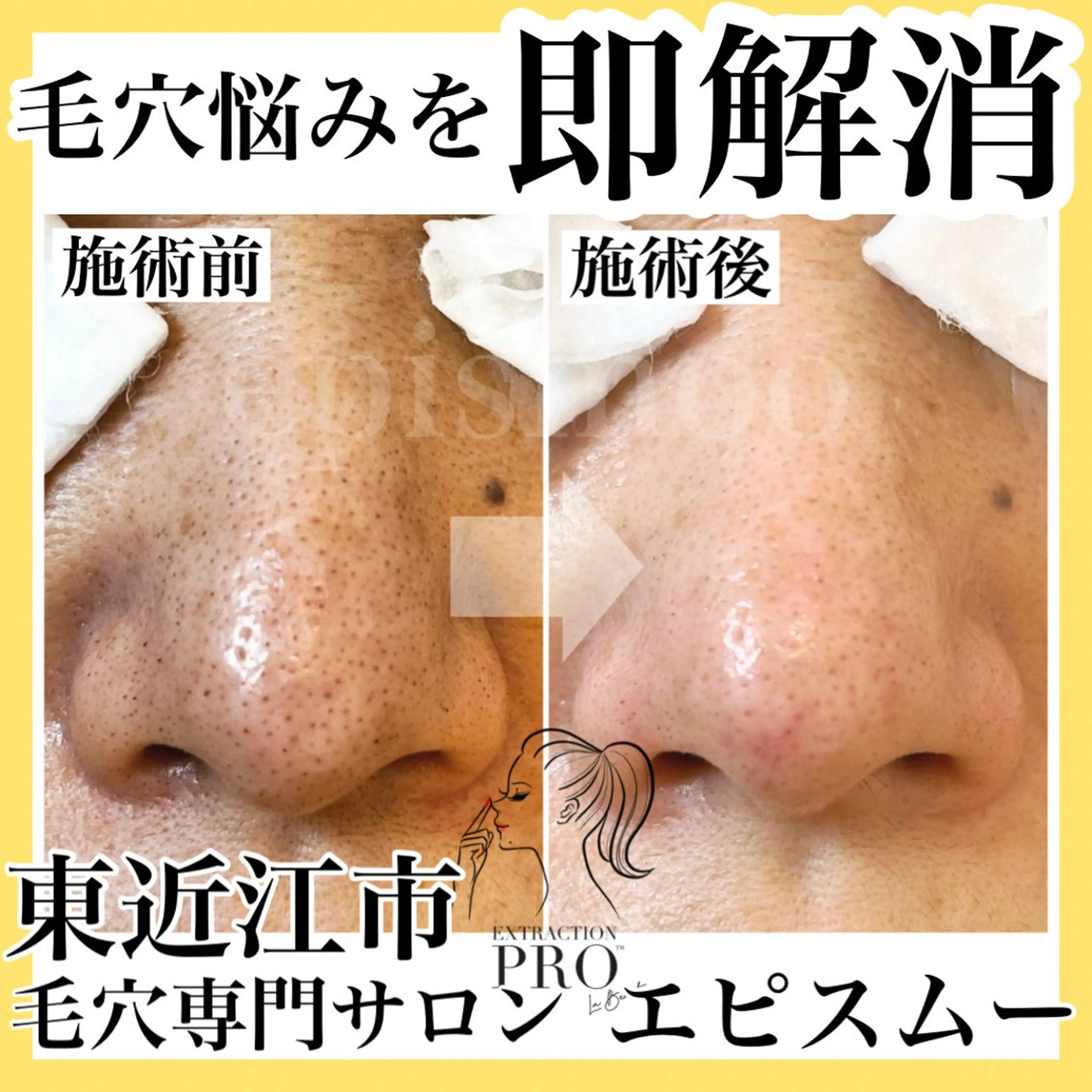 epismoo 脱毛/HBL/毛穴の眉毛・アイブロウイメージ