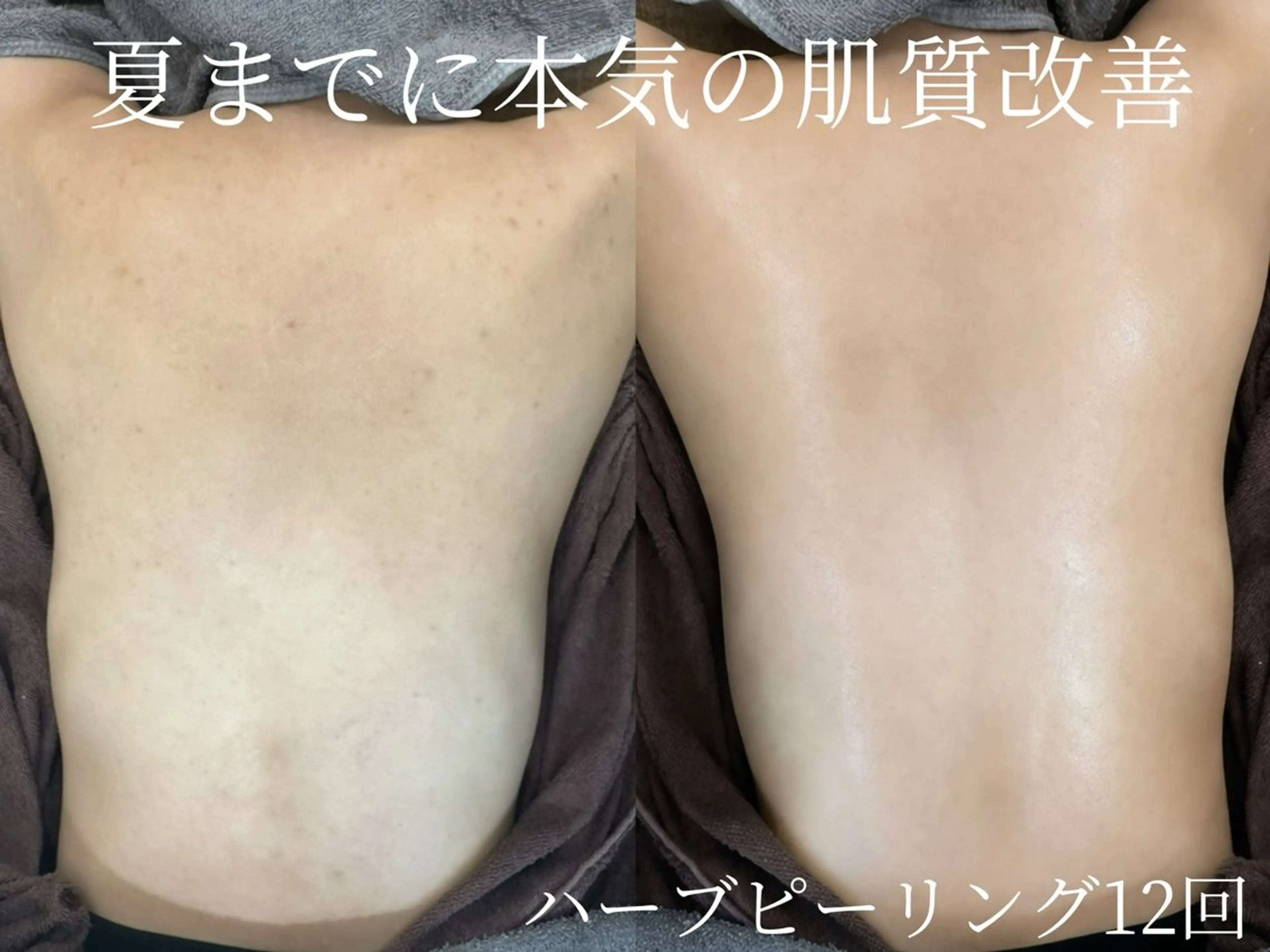 31日限定🌸【背中ニキビ・跡ケア🌿】ハーブピーリング＋背中マッサージ✨の写真