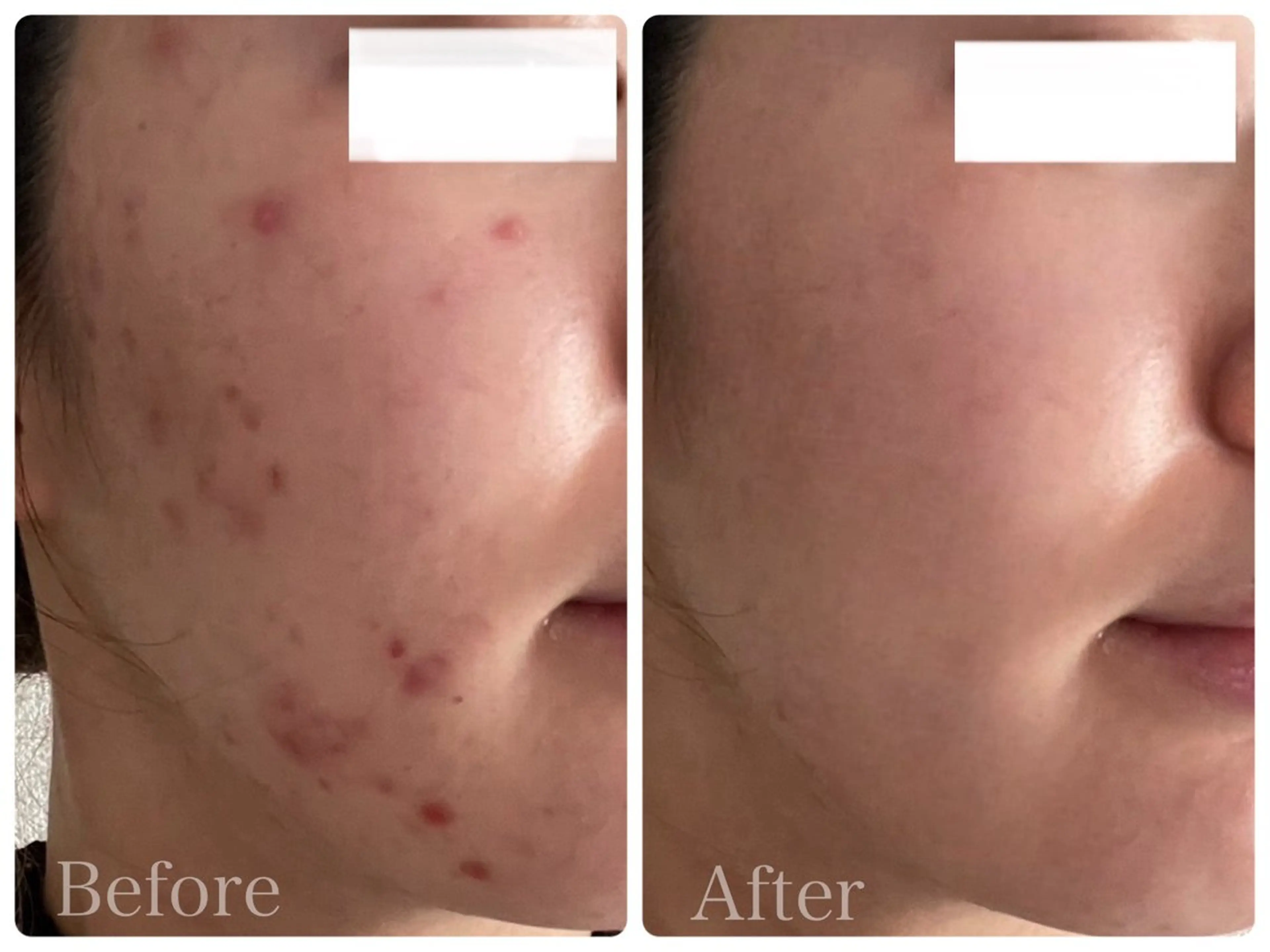 エステ リラク ニキビ・ 肌荒れ専門店のエステ・リラクイメージ