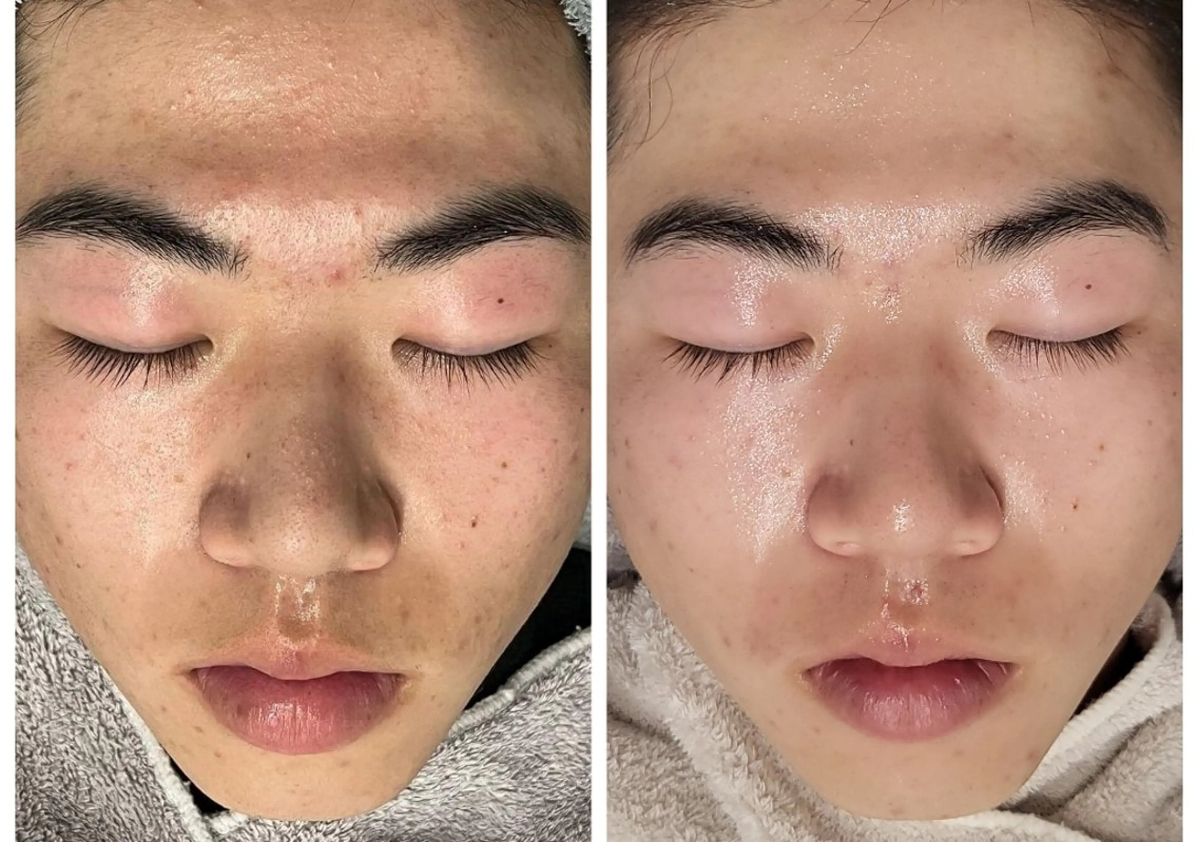 minimoだけの特別価格！！￥5,500→￥4,400！！NEW✩.*˚角栓ごっそり取れる！毛穴お掃除！60分の写真