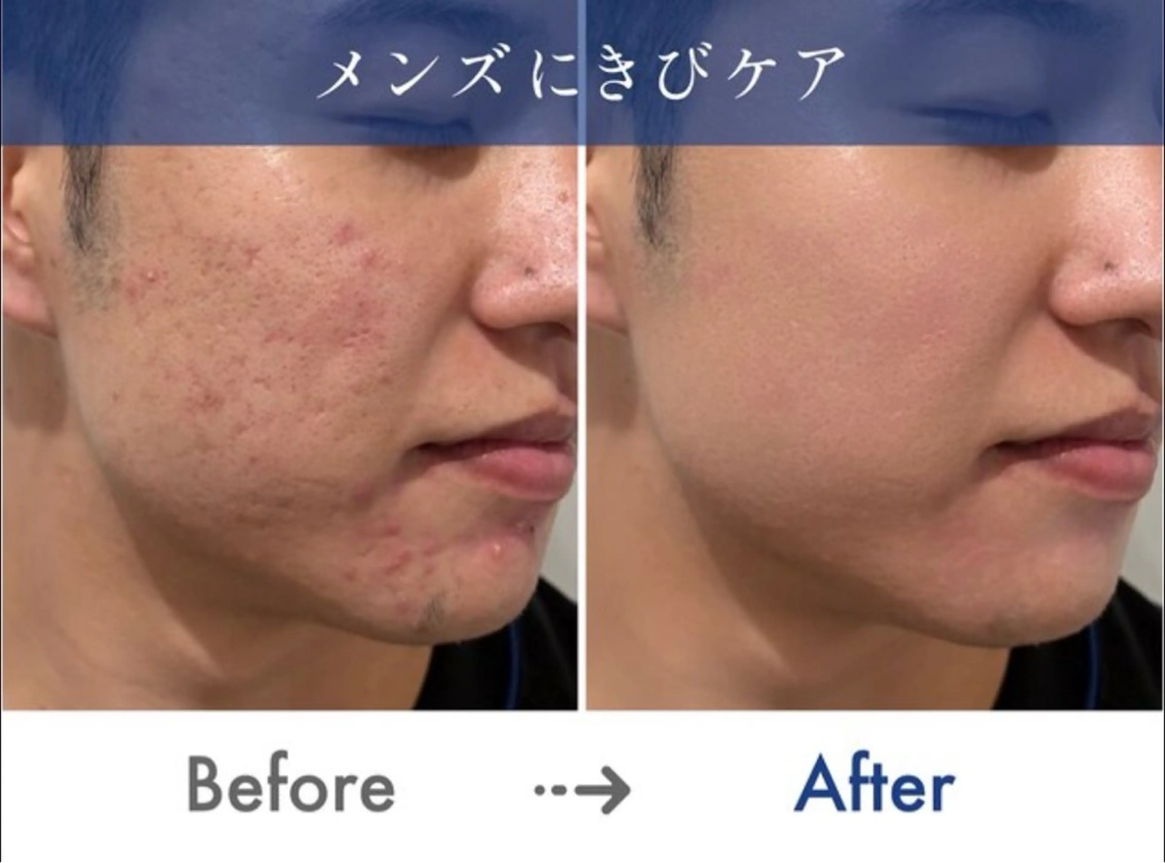 ✨モニター価格得✨【ニキビ/ニキビ跡/毛穴】ハーブピーリング🌿の写真