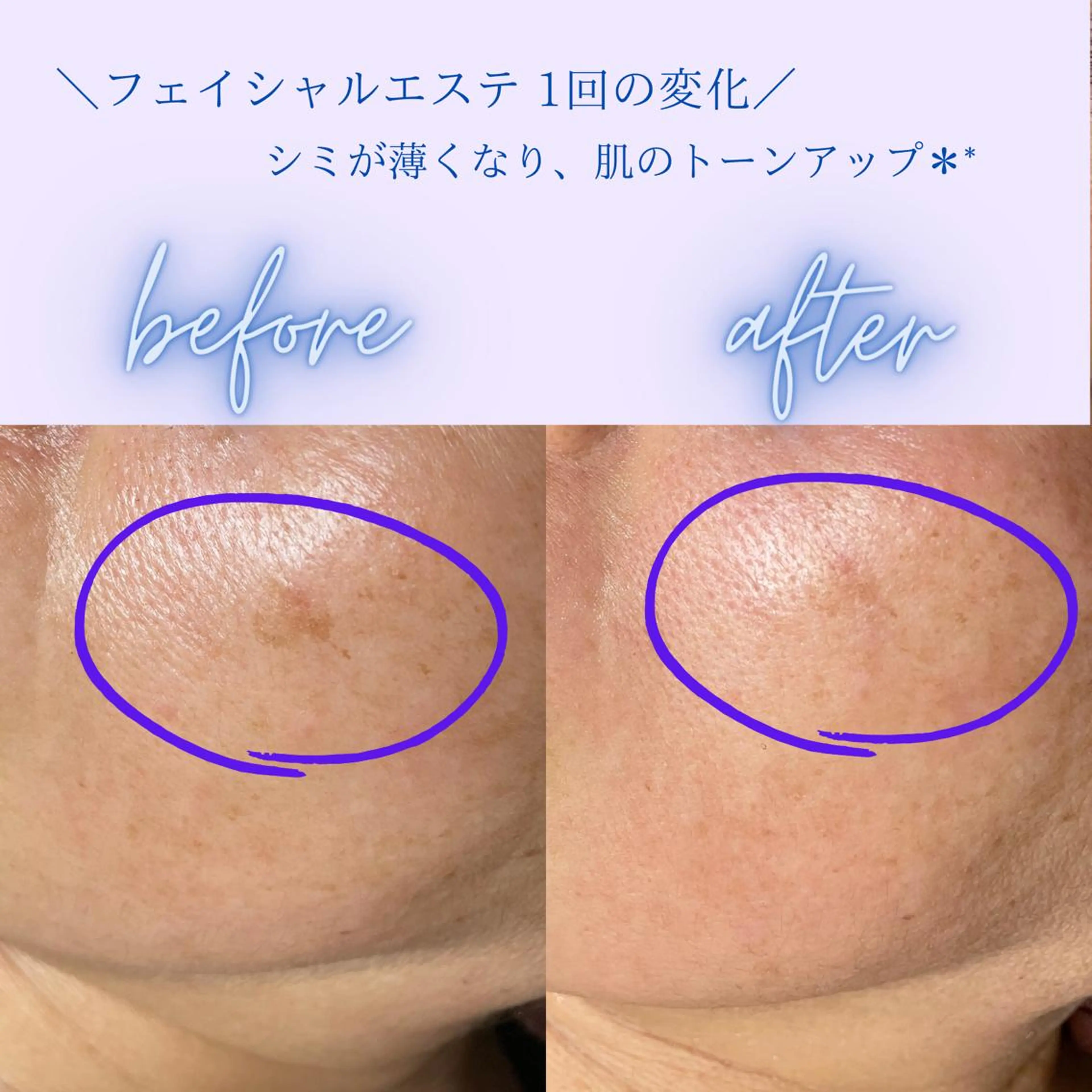 《潤いとトーンアップ✨》フェイシャルエステの写真