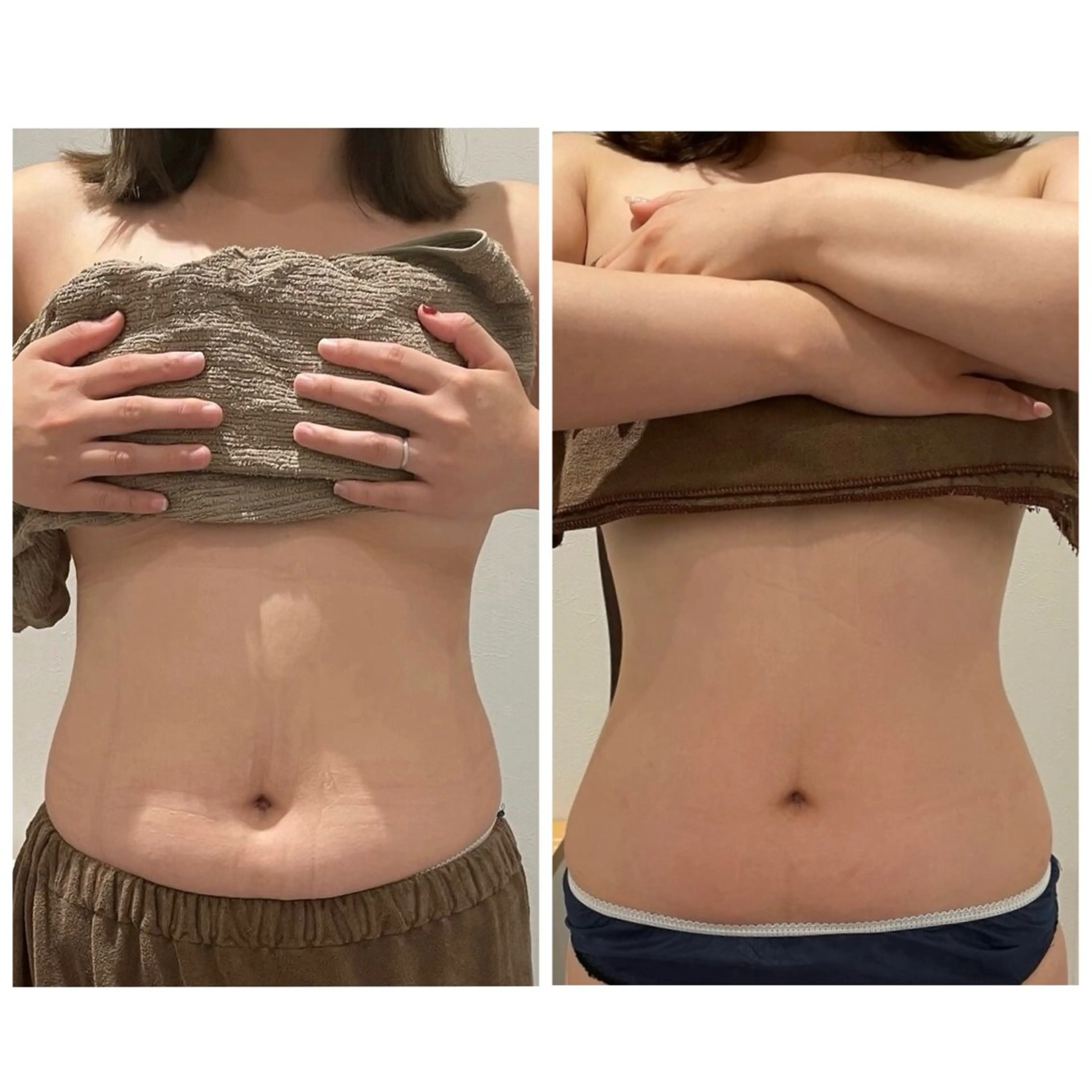 【サイズも厚みも徹底改善】燃焼/スリムアップ体験(上半身)キャビテーションの写真