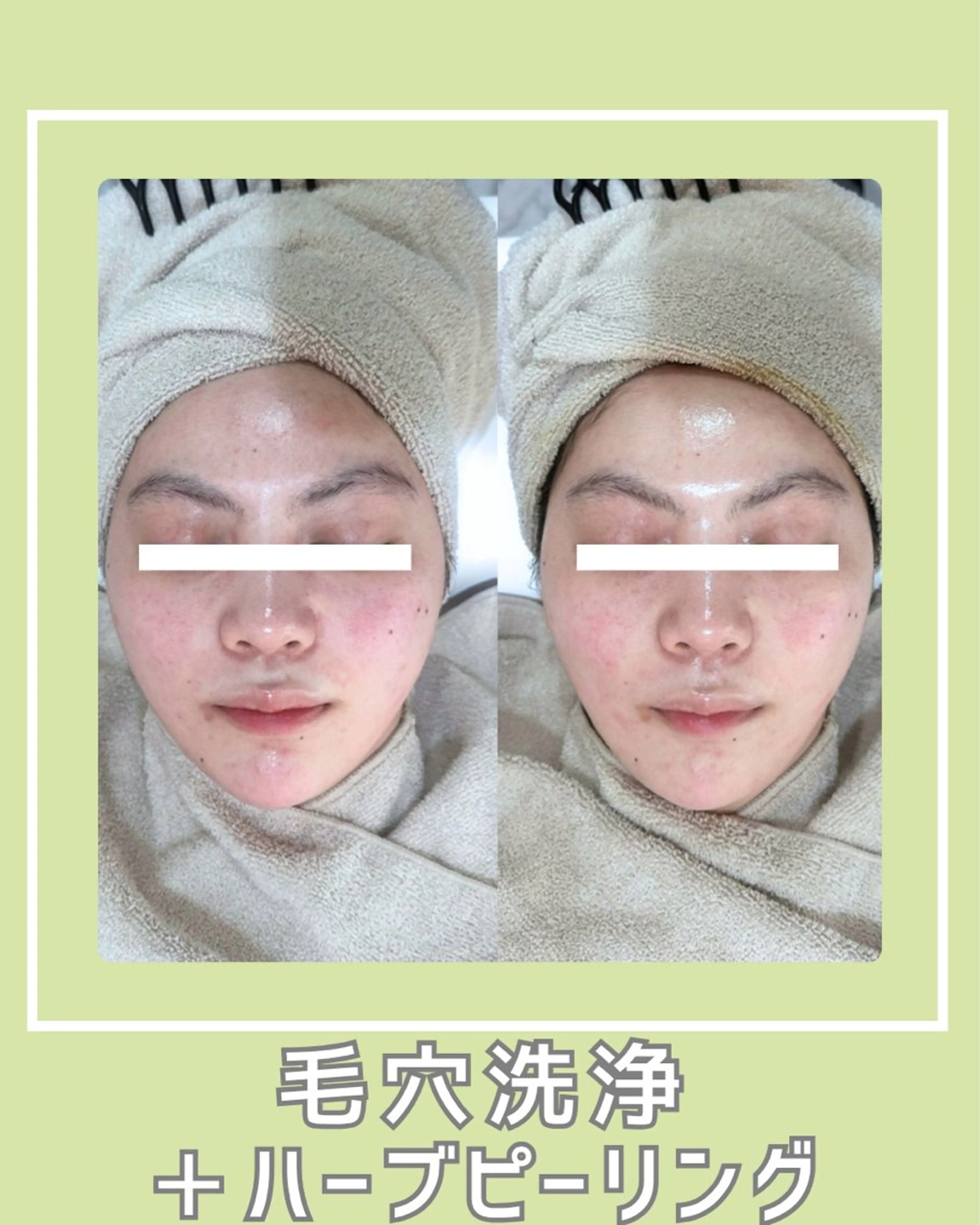 エステ |ピーリング・毛穴| soina神楽坂のエステ・リラクイメージ