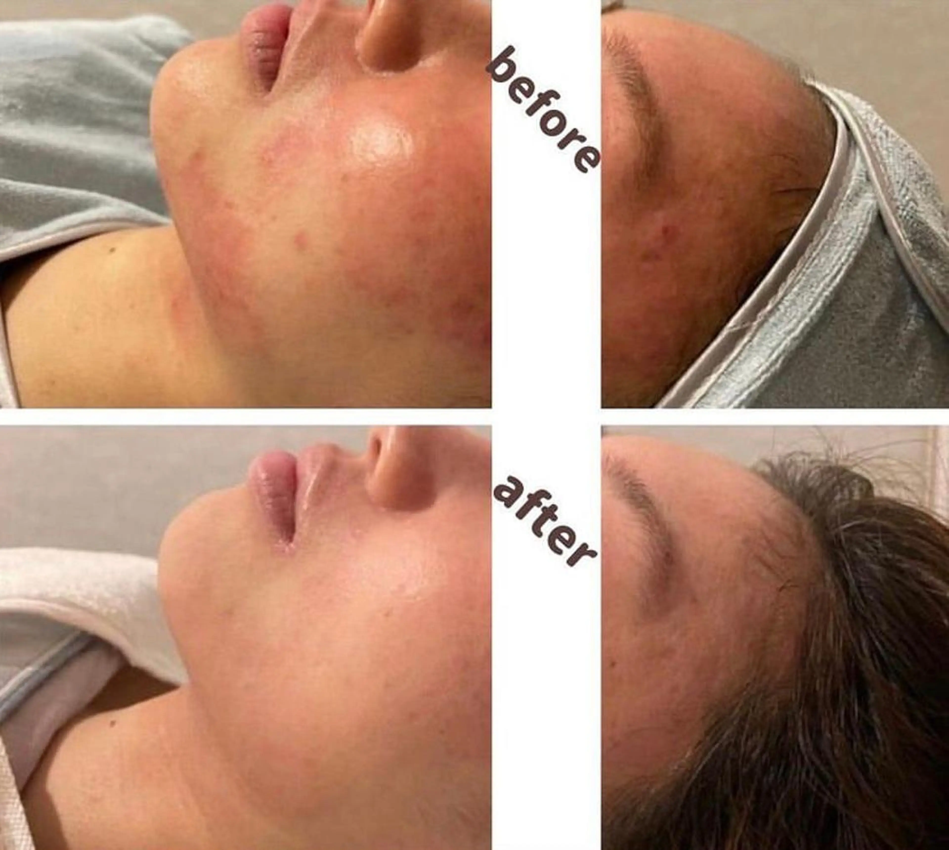 ニキビケア,赤ら顔ケア,美白＆跡ケア★お悩み別で選べるイオン導入！クレンジング→洗顔→選べるイオン導入→パックの写真