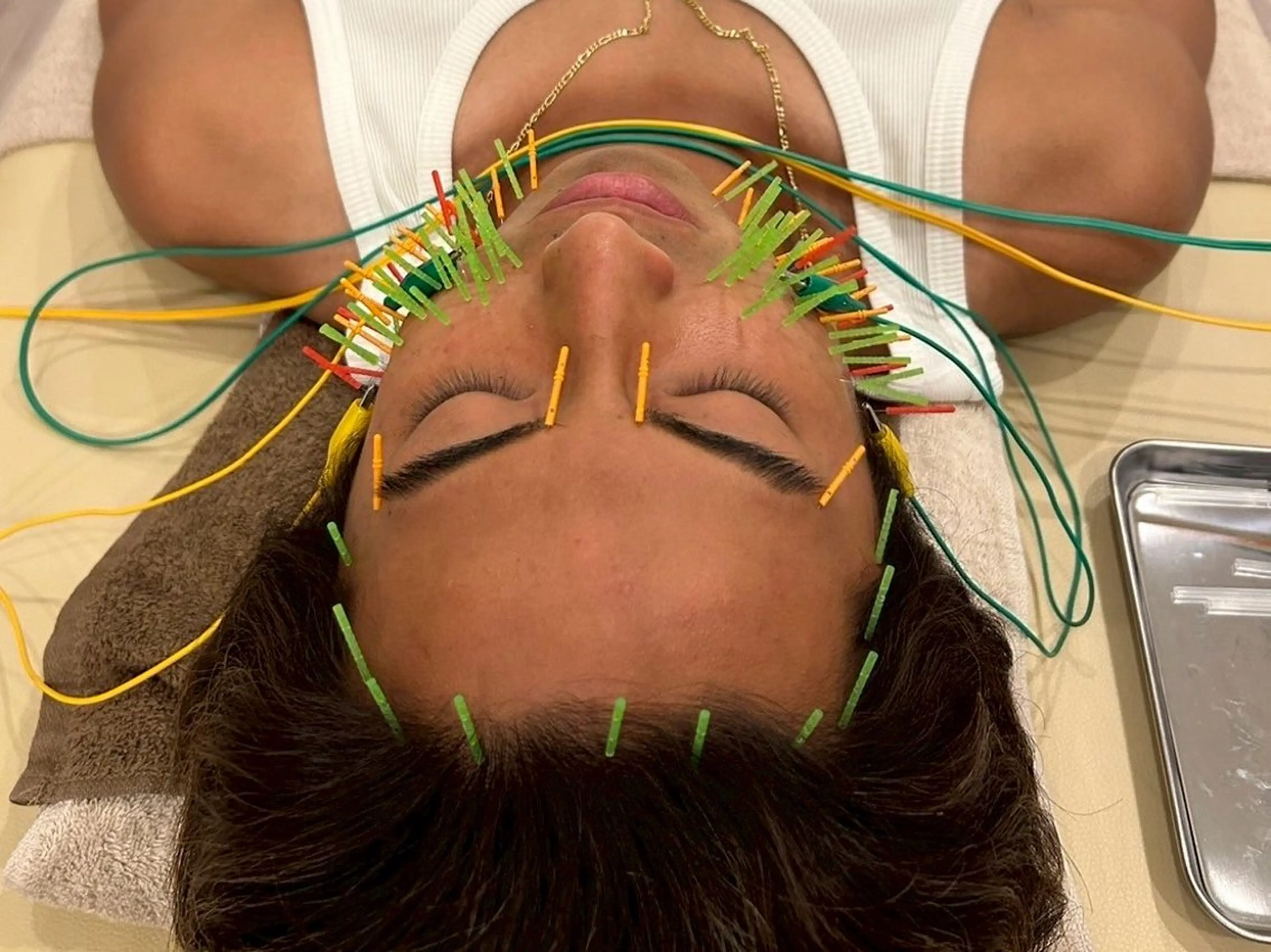 エステ リラク 美容鍼灸Solana所属・肌質改善×美容鍼 ゆいのエステ・リラクイメージ