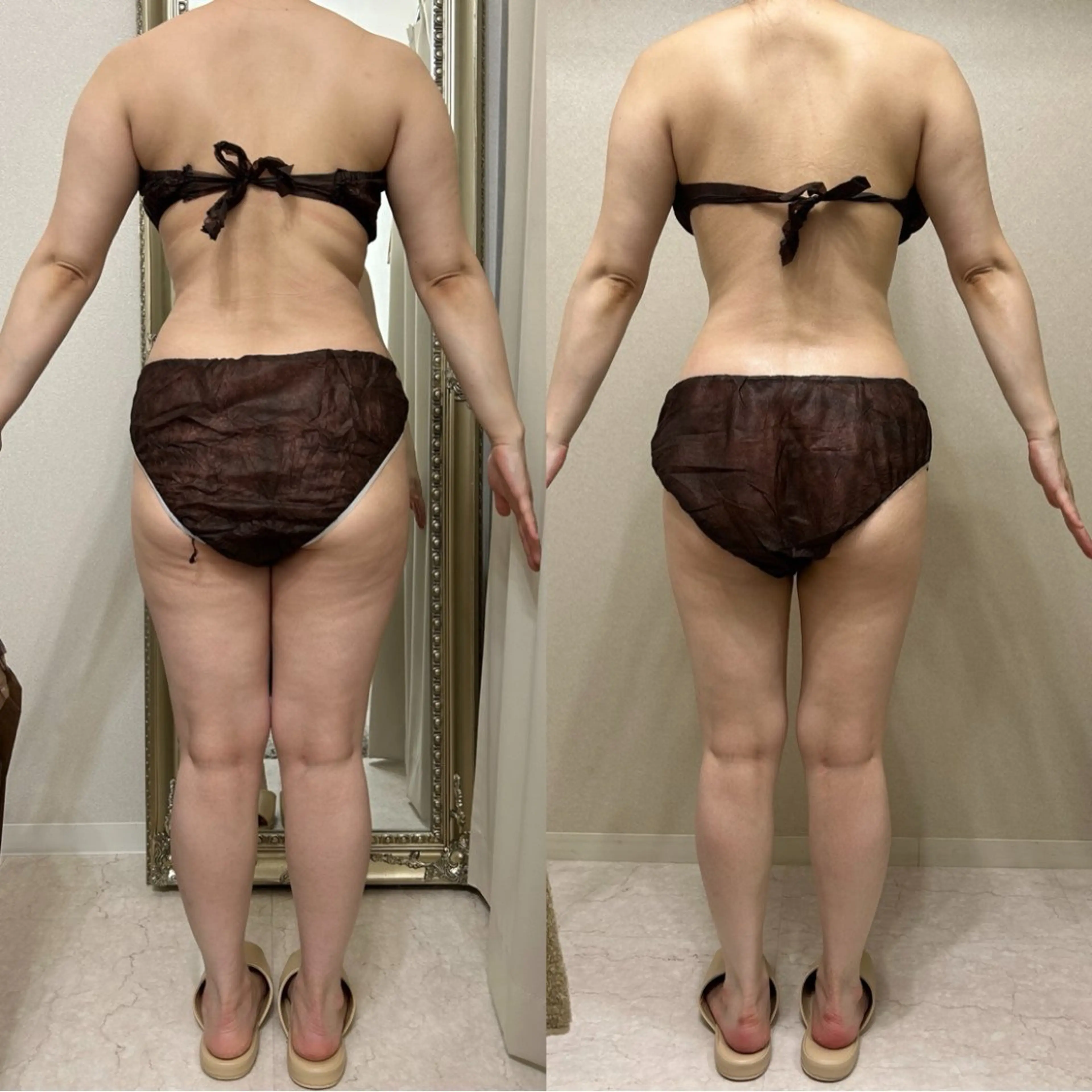 🫧当日ご予約限定🫧ハイパーナイフ90分｜速攻スリム体験✨️の写真