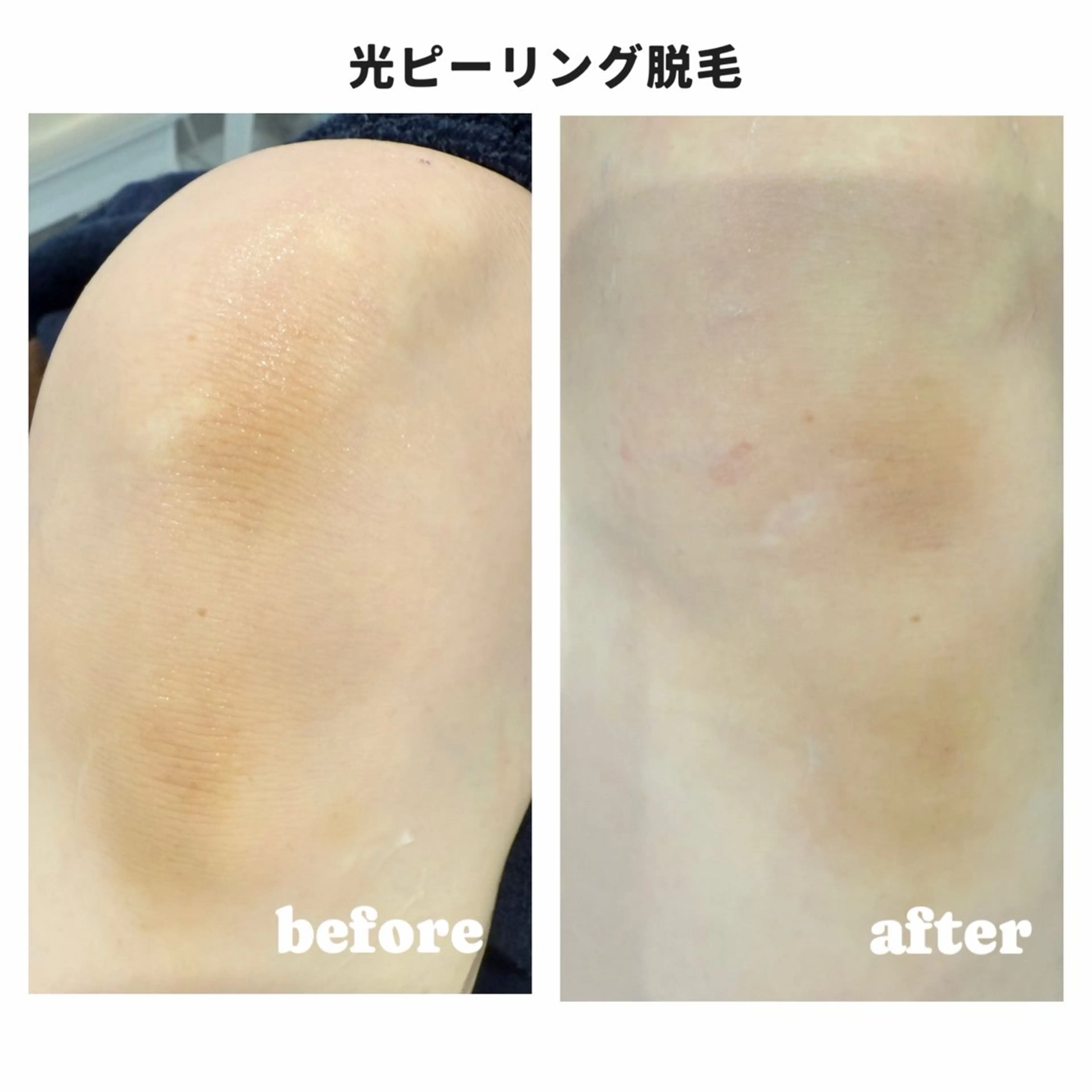 Beauty Salon Moonstone所属・Moonstone 男女•キッズ脱毛のエステ・リラクイメージ