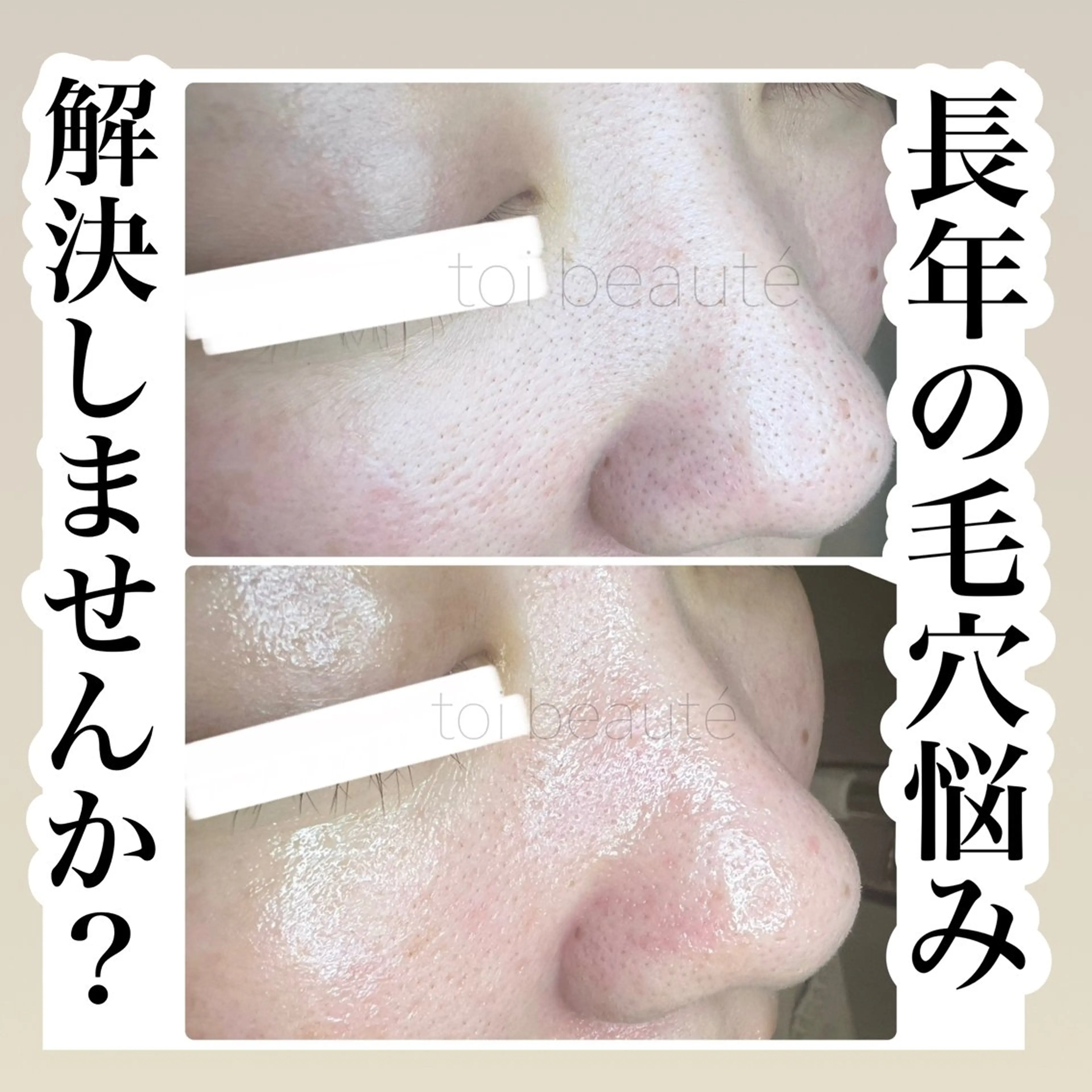 毛穴エクストラクションで長年の悩みを解消しませんか？の写真
